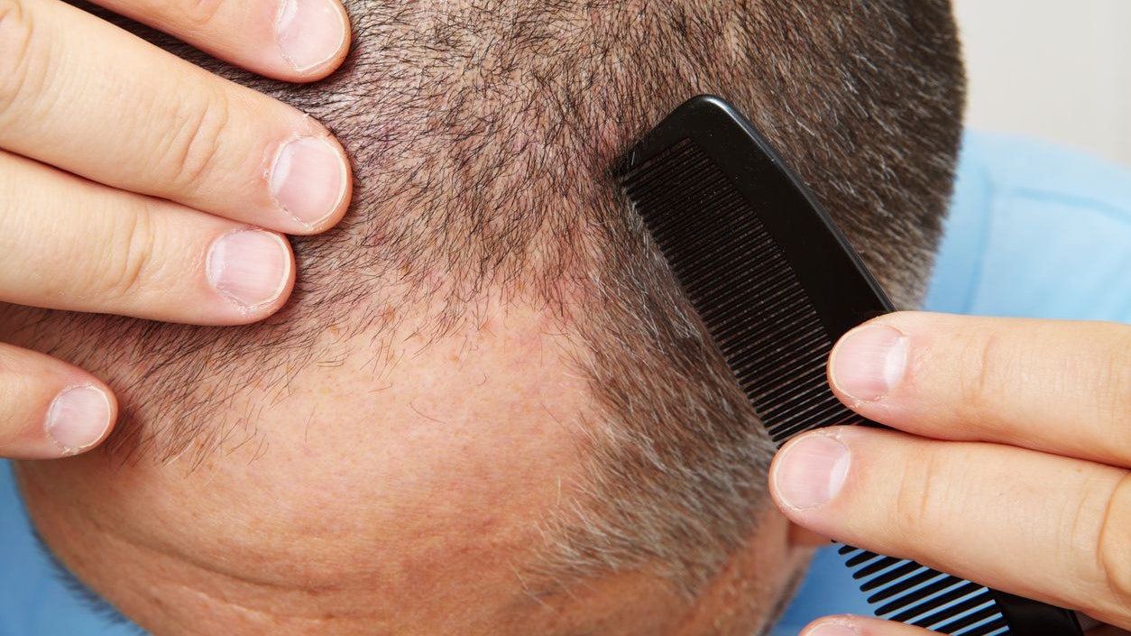 Heute.at - Bekannter Süßstoff bringt Haare wieder zum Wachsen