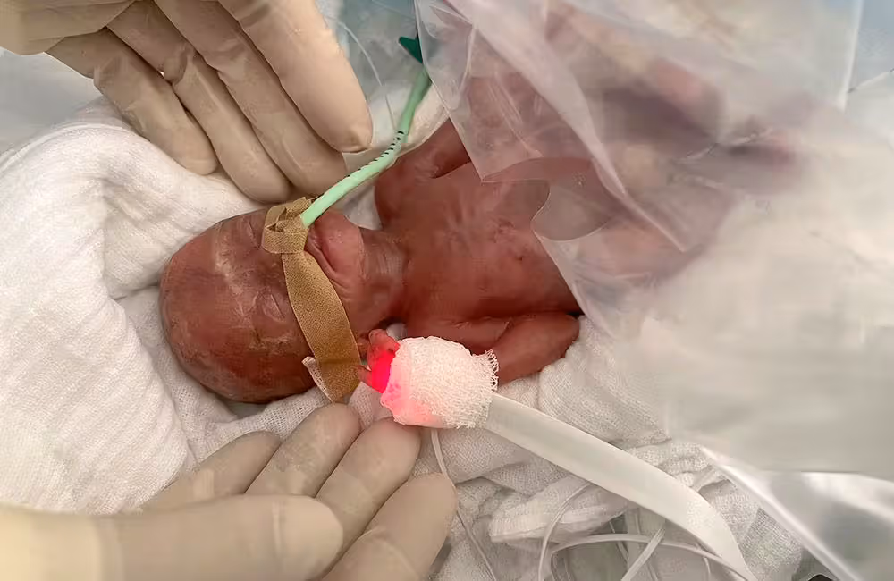 Ein Mädchen, das bei der Geburt nur 300 Gramm wog und 16 Wochen zu früh geboren wurde, hat dank intensiver medizinischer Betreuung und moderner Technik überlebt.