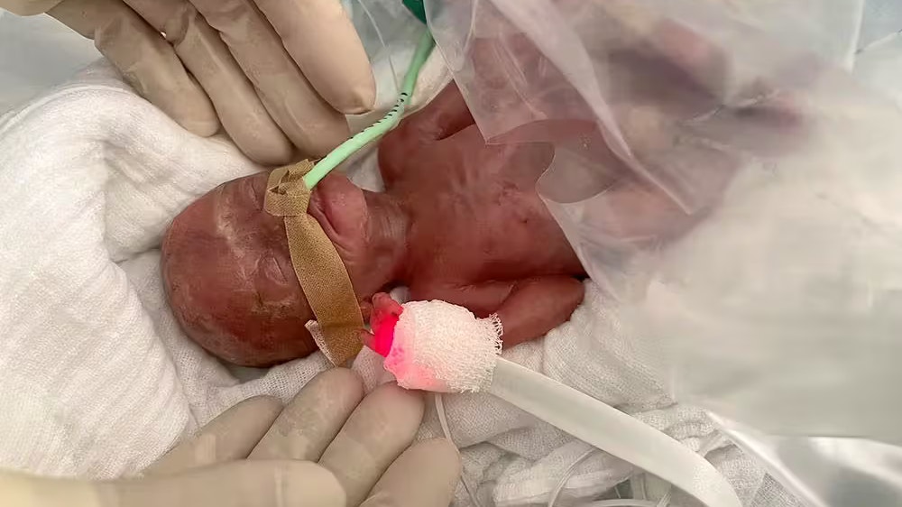 Heute.at - Mädchen wiegt bei seiner Geburt nur 300 Gramm