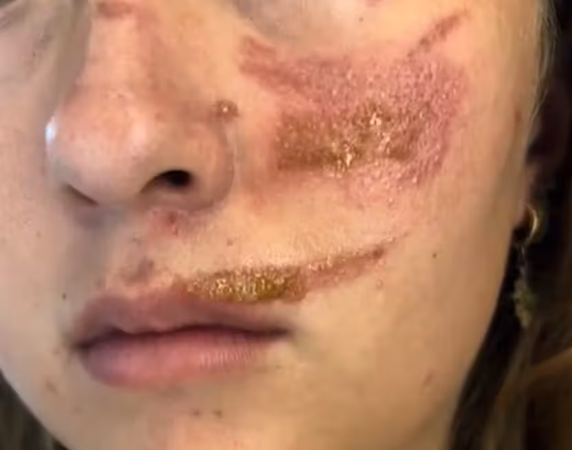 Die Britin Ellise hatte auf ihrer Vietnam-Reise auf einmal Wunden am ganzen Körper.Tiktok/asia.ellise