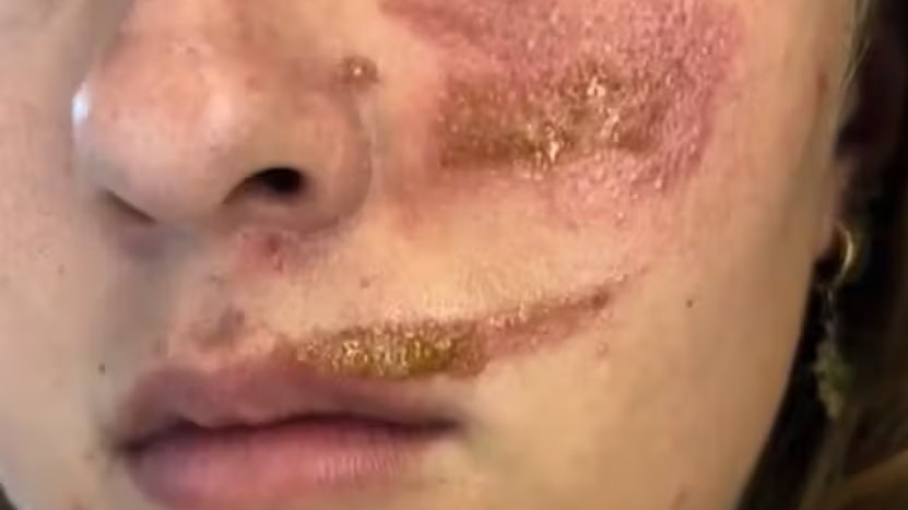 Heute.at - Touristin hat plötzlich Wunden am ganzen Körper