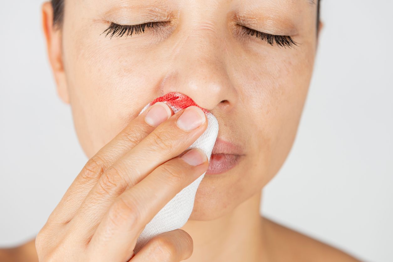 Nasenbluten kann verschiedene Ursachen haben, meist ist es jedoch harmlos.