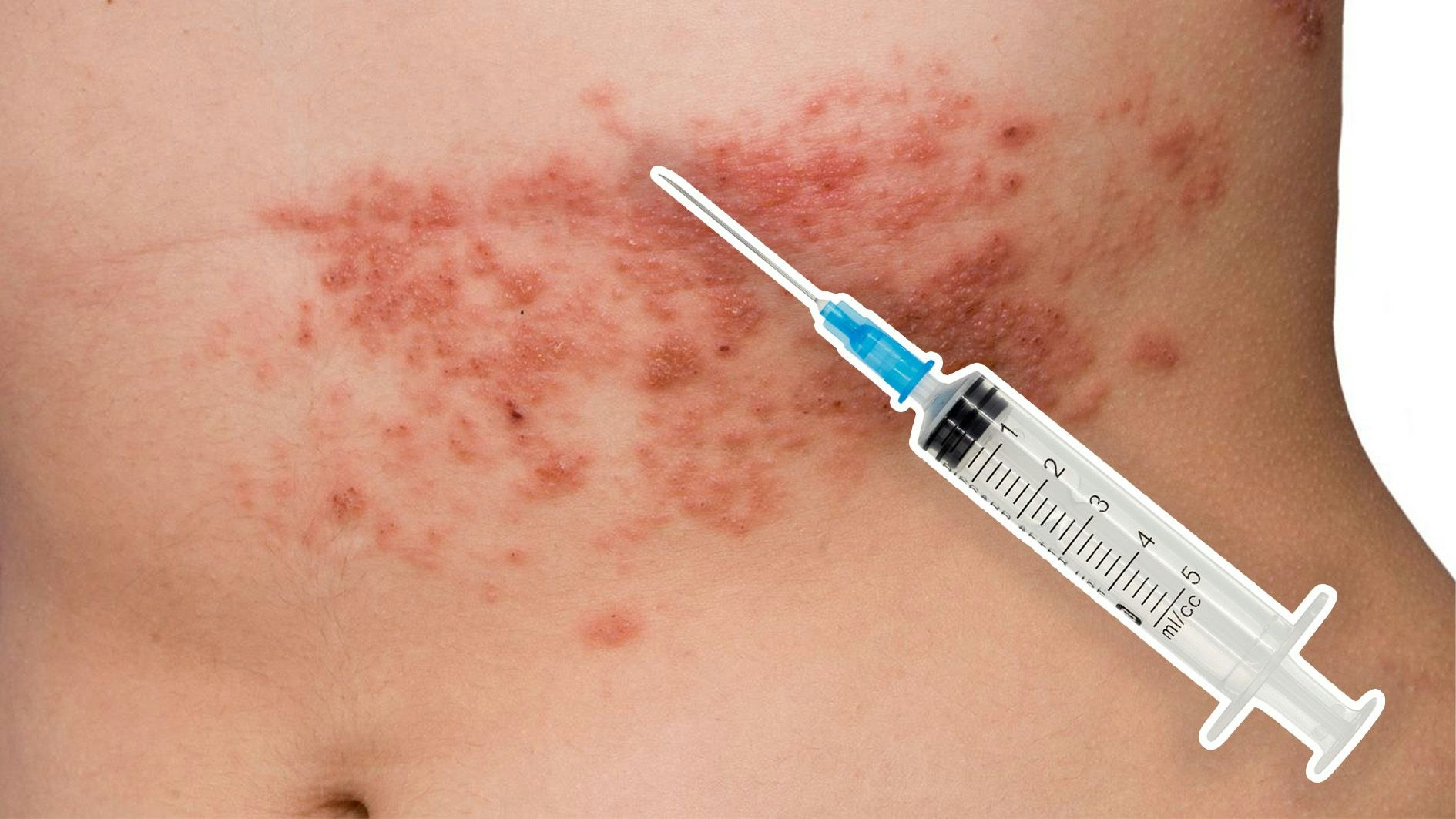 Heute.at - Kostenlose Gürtelrose-Impfung ab 60 Jahren gestartet