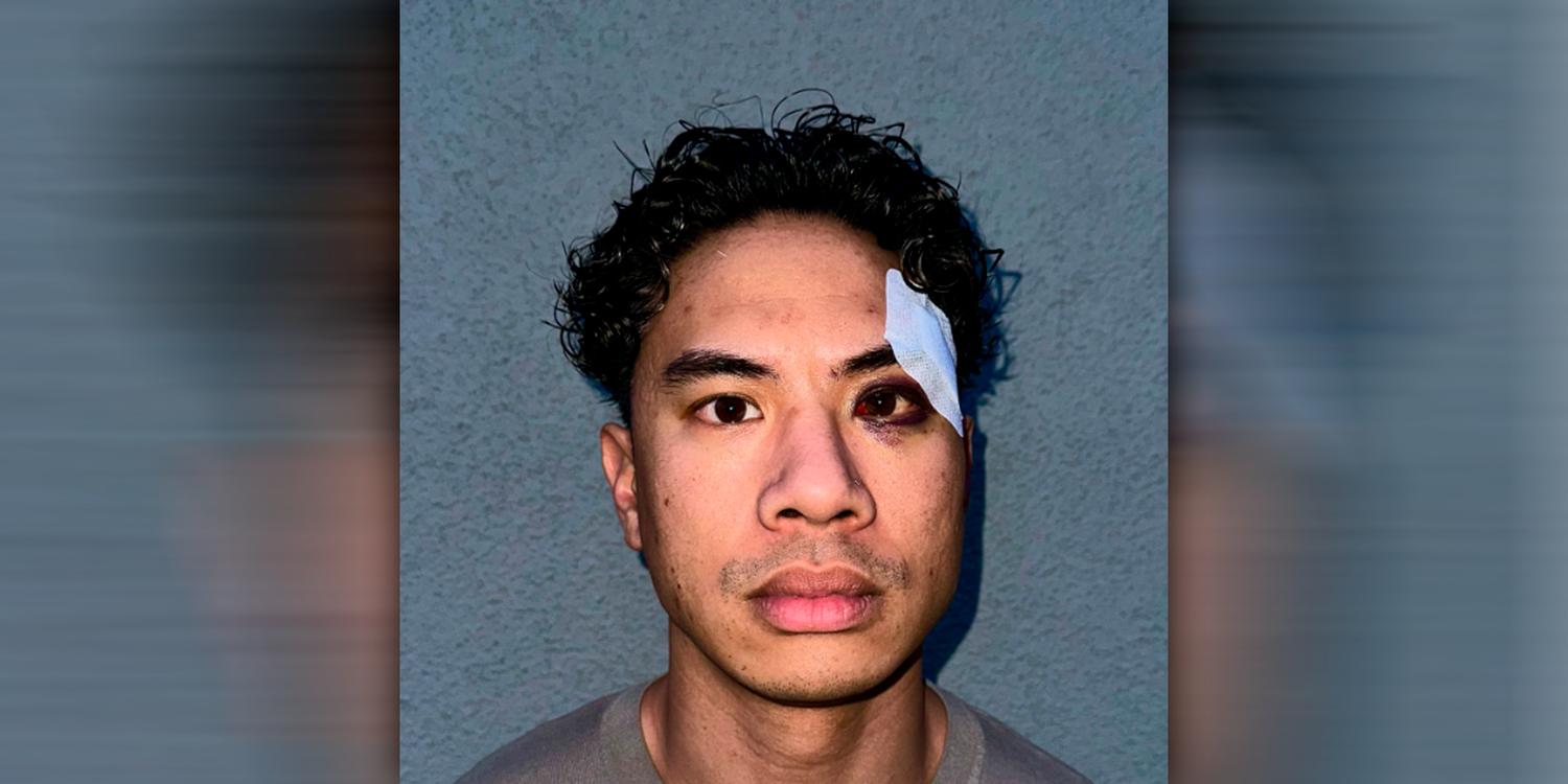 Comedian Tutty zeigt seine Verletzungen.