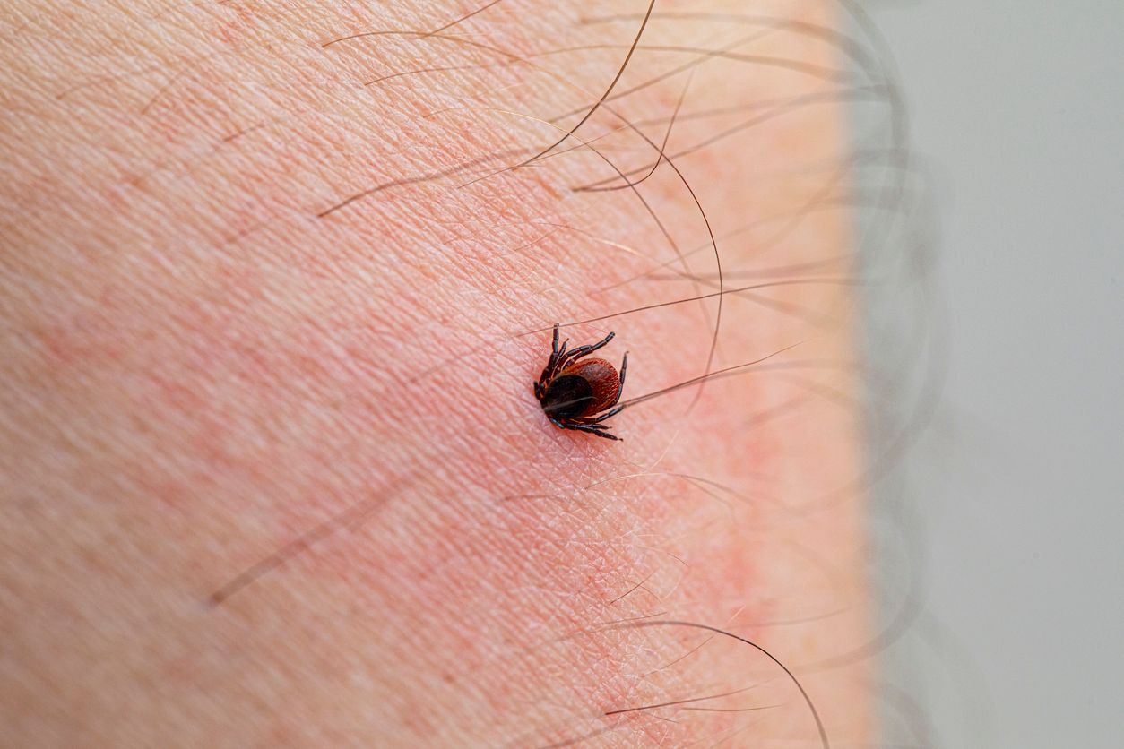 In den USA starb ein 47-Jähriger an einer durch einen Zeckenstich ausgelösten Fleischallergie, von Fachleuten Alpha-Gal-Syndrom (AGS) genannt.