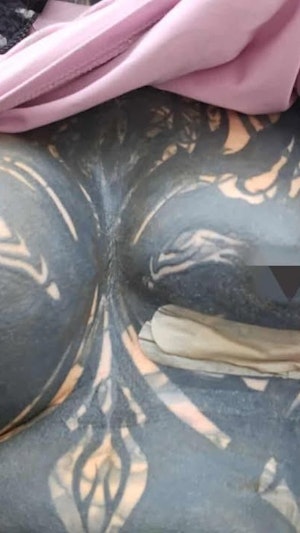 Brust-OP Komplikationen: Nach missglücktem Eingriff in Prag kämpft eine 26-jährige Wienerin mit schweren gesundheitlichen Folgen und Entstellung.