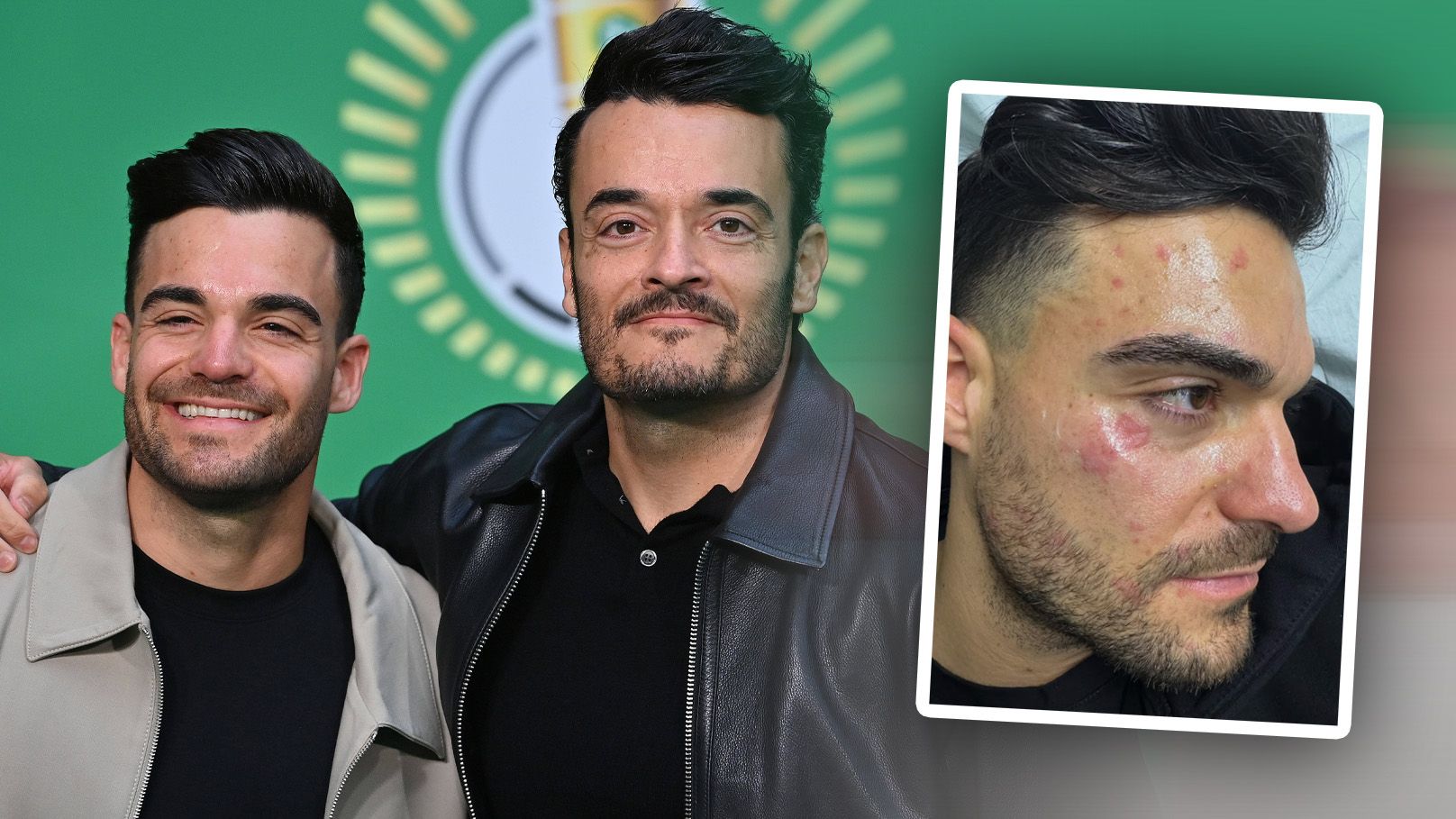 Giovanni Zarrellas Bruder Stefano hatte einen Unfall in der Küche.