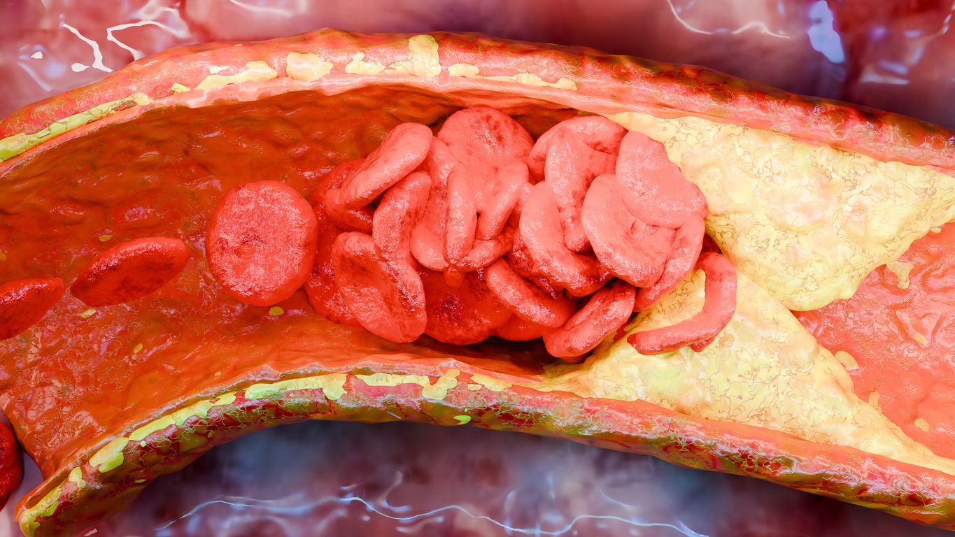 Verstopfte Gefäße, verdickte Arterien und Venen führen zu Infarkten