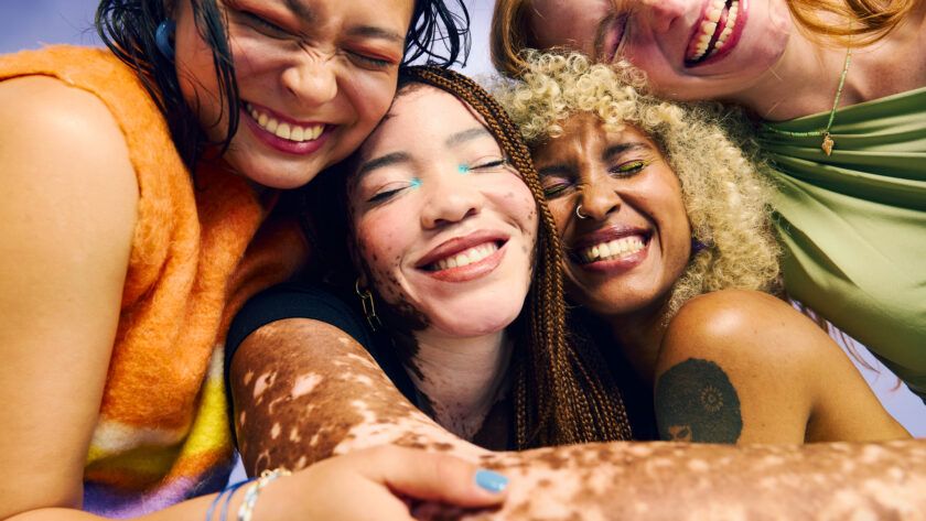 Heute.at - Mut zur Haut: Wie man Vitiligo-Betroffene stärkt