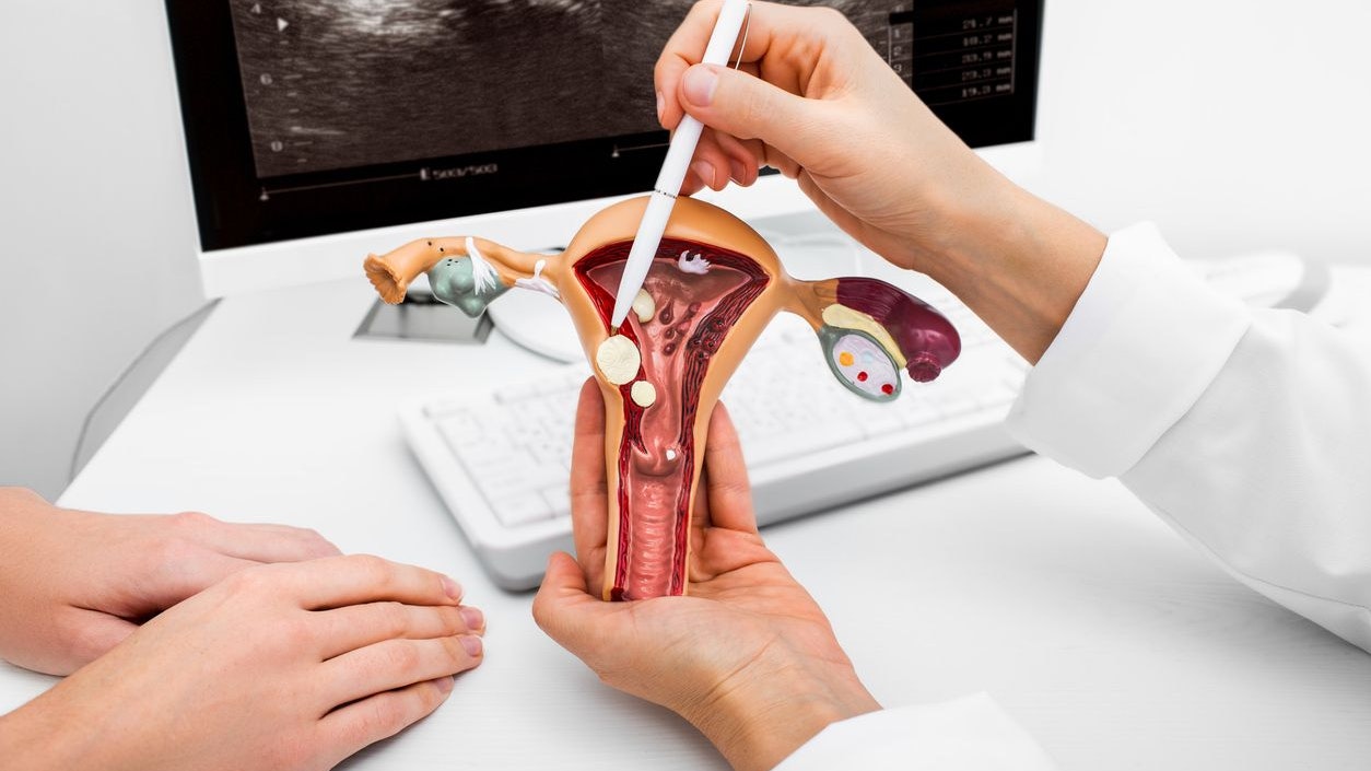 Close-up anatomical model of the uterus with pathologies. Gynecologist showing the polyps of the uterus. Gynecological diseases and treatments