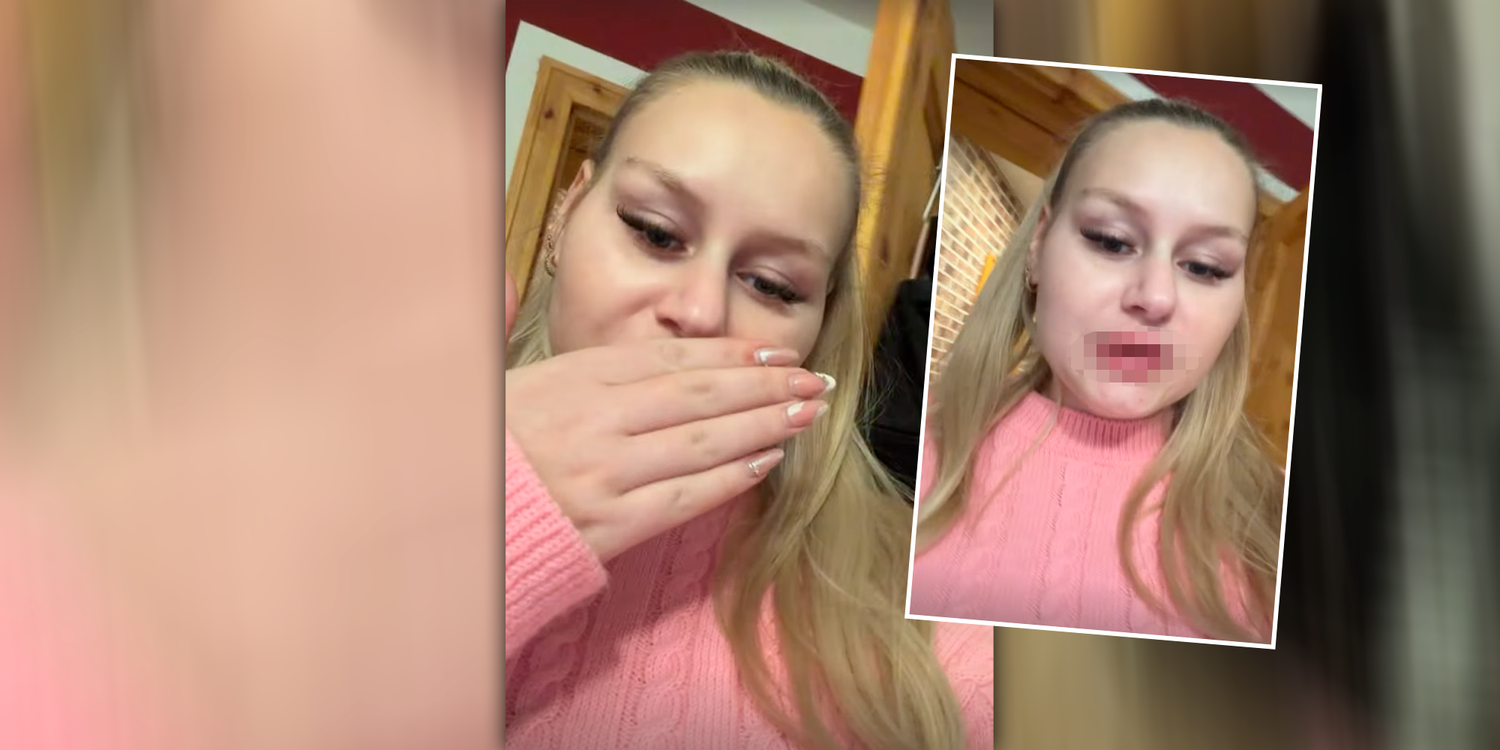 Heute.at - Wollny zeigt aufgespritzte Lippen: Katastrophe