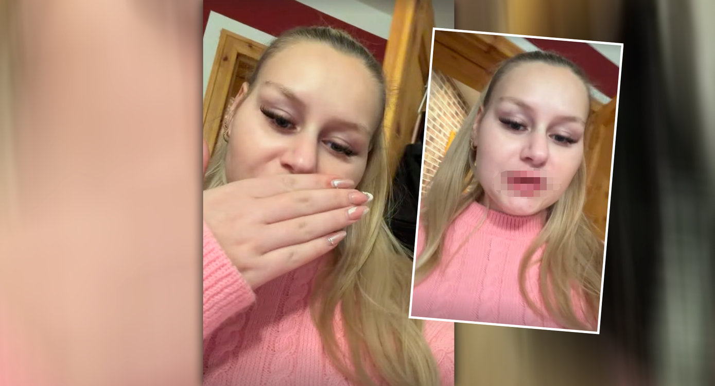 Heute.at - Wollny zeigt aufgespritzte Lippen: Katastrophe