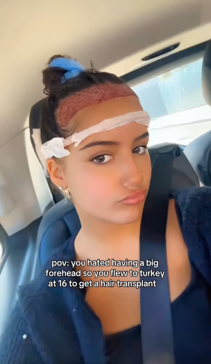 Heute.at - Haartransplantationen bei Frauen bergen Risiken