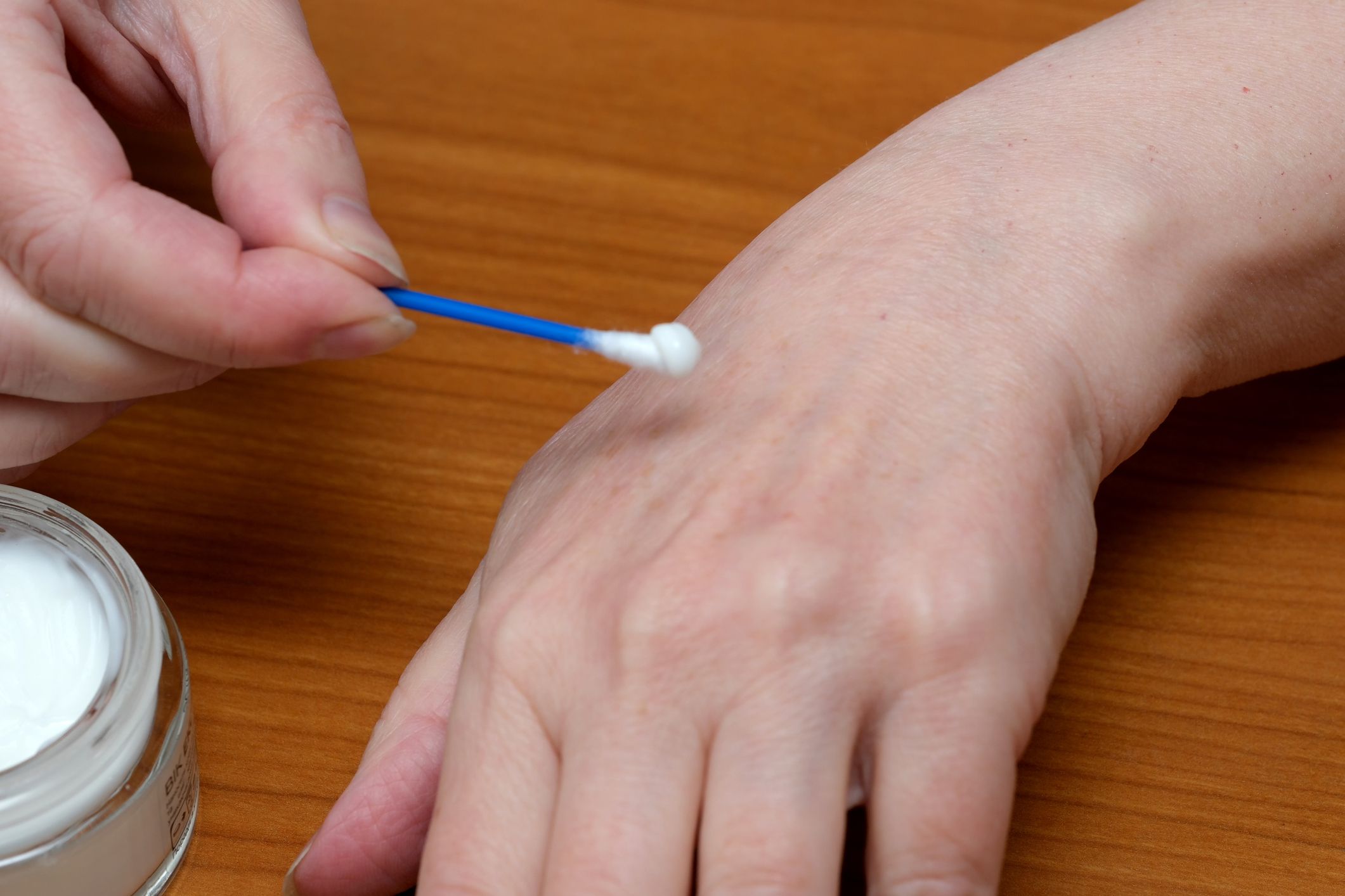 Heute.at - Lepra nach Jahrzehnten wieder in Europa aufgetaucht