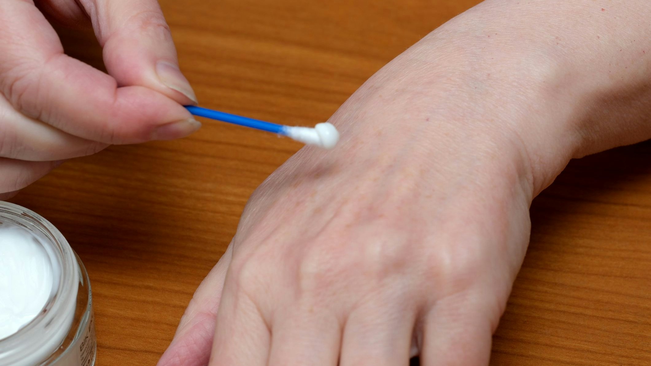 Heute.at - Lepra nach Jahrzehnten wieder in Europa aufgetaucht