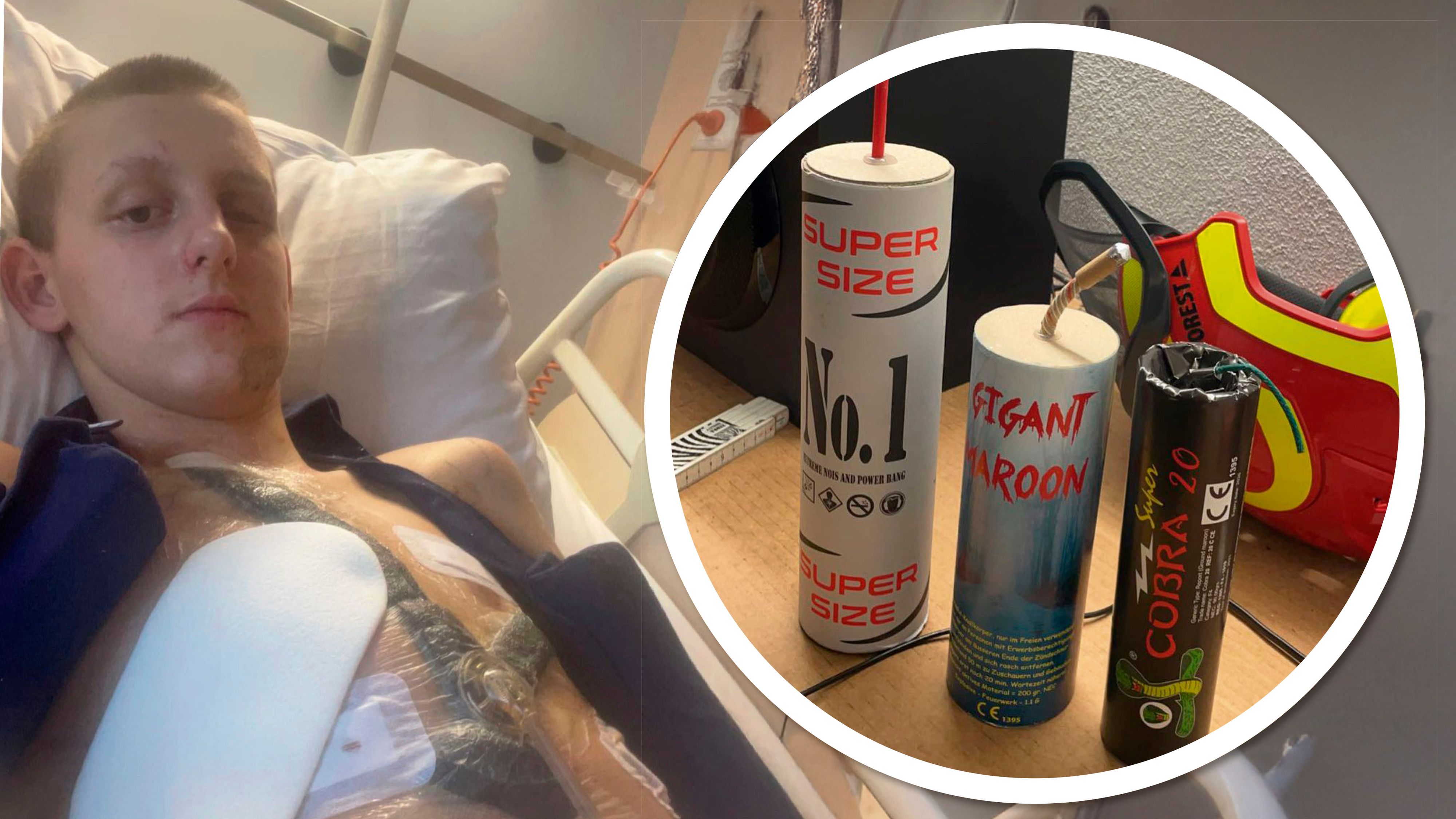 Heute.at - Opfer nach 30 OPs: Böller kostete mich fast das Leben