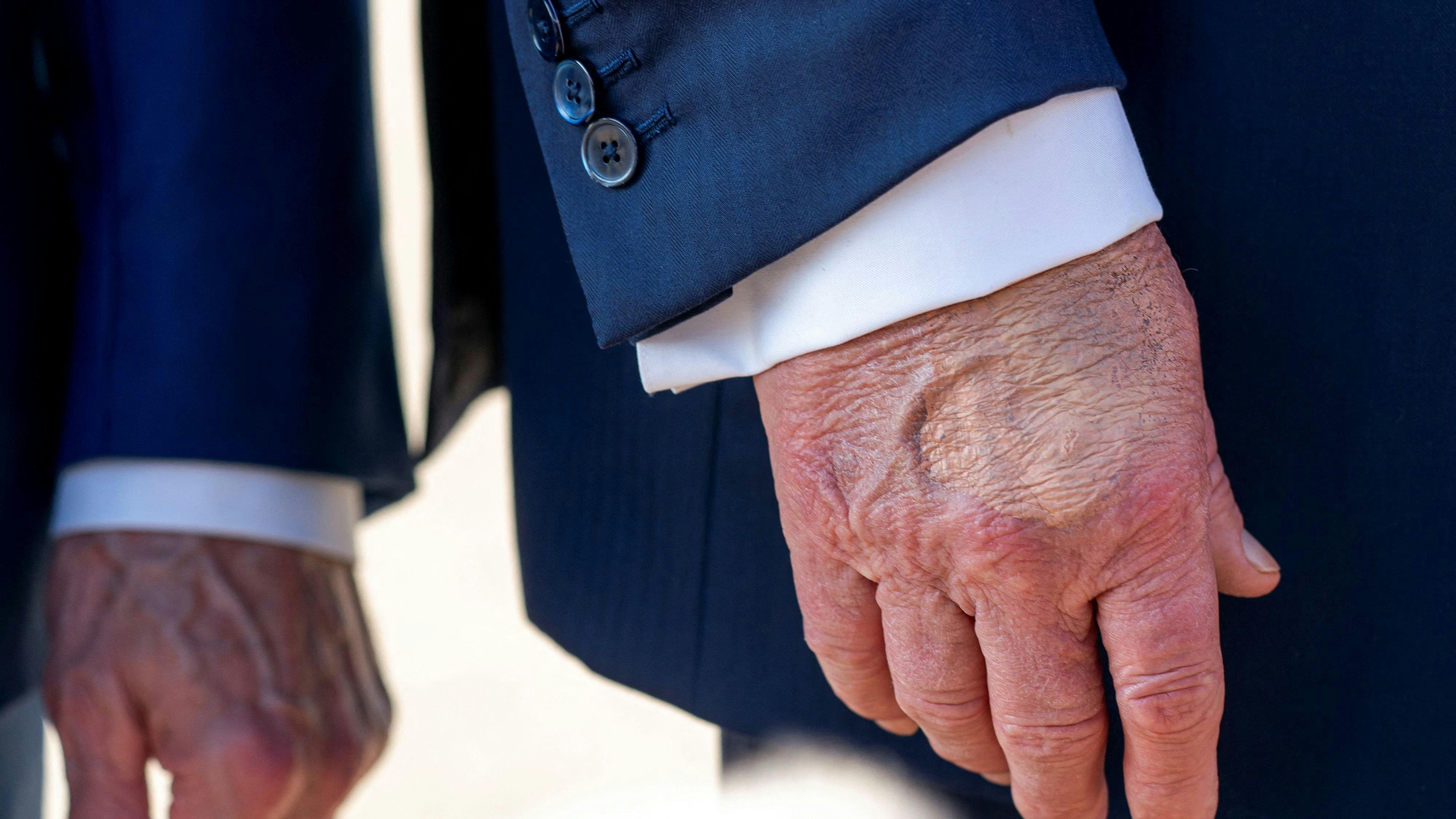 Wiederholt waren sichtbare Blutergüsse an Trumps rechten Hand zu sehen, die teilweise auch mit starker Schminke oder Pflastern verdeckt waren.