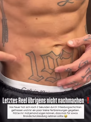 Laurenz Pesch ziegt seine Verbrennungen.