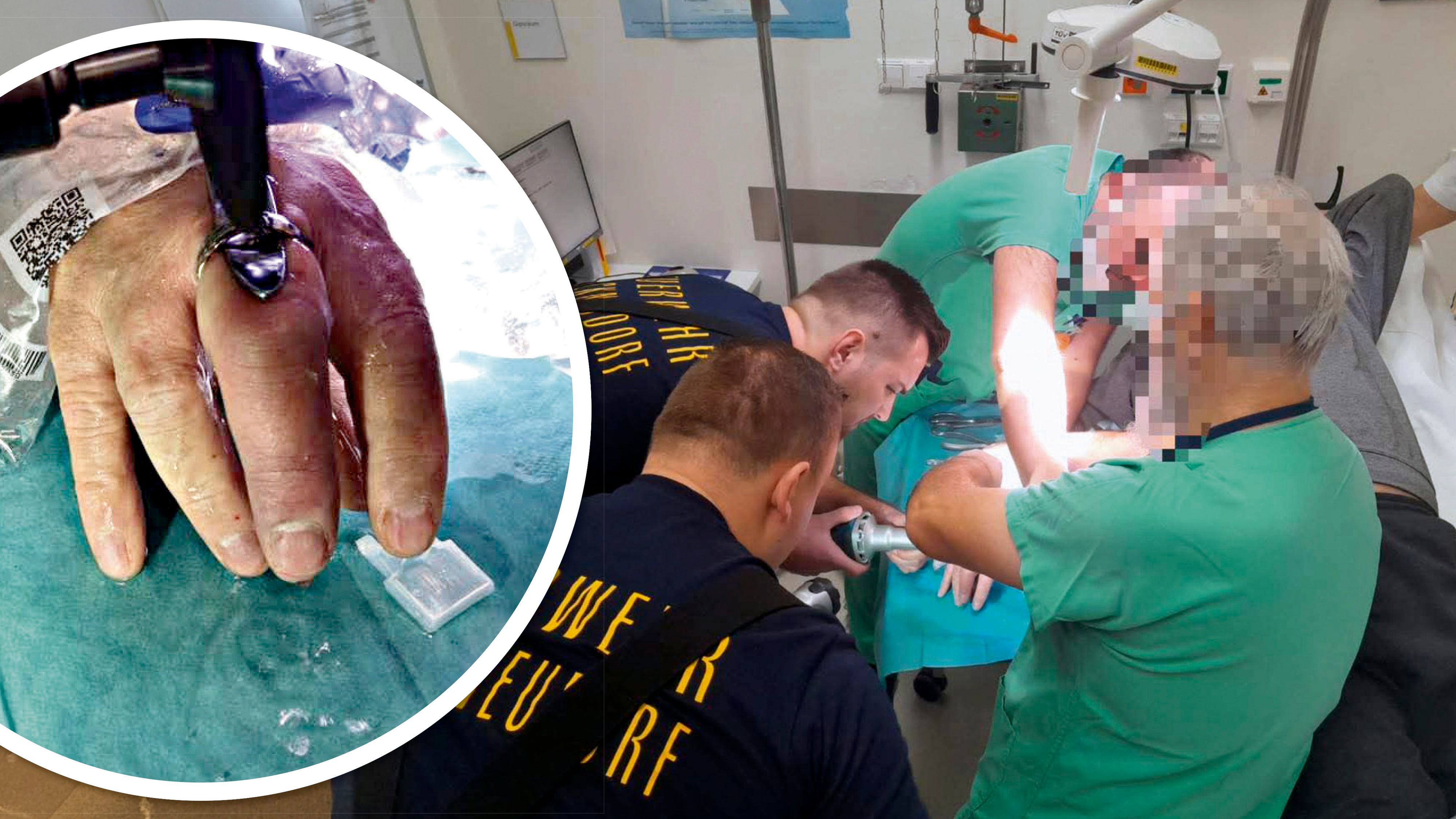 Heute.at - Feuerwehr muss Ehering von Finger schneiden