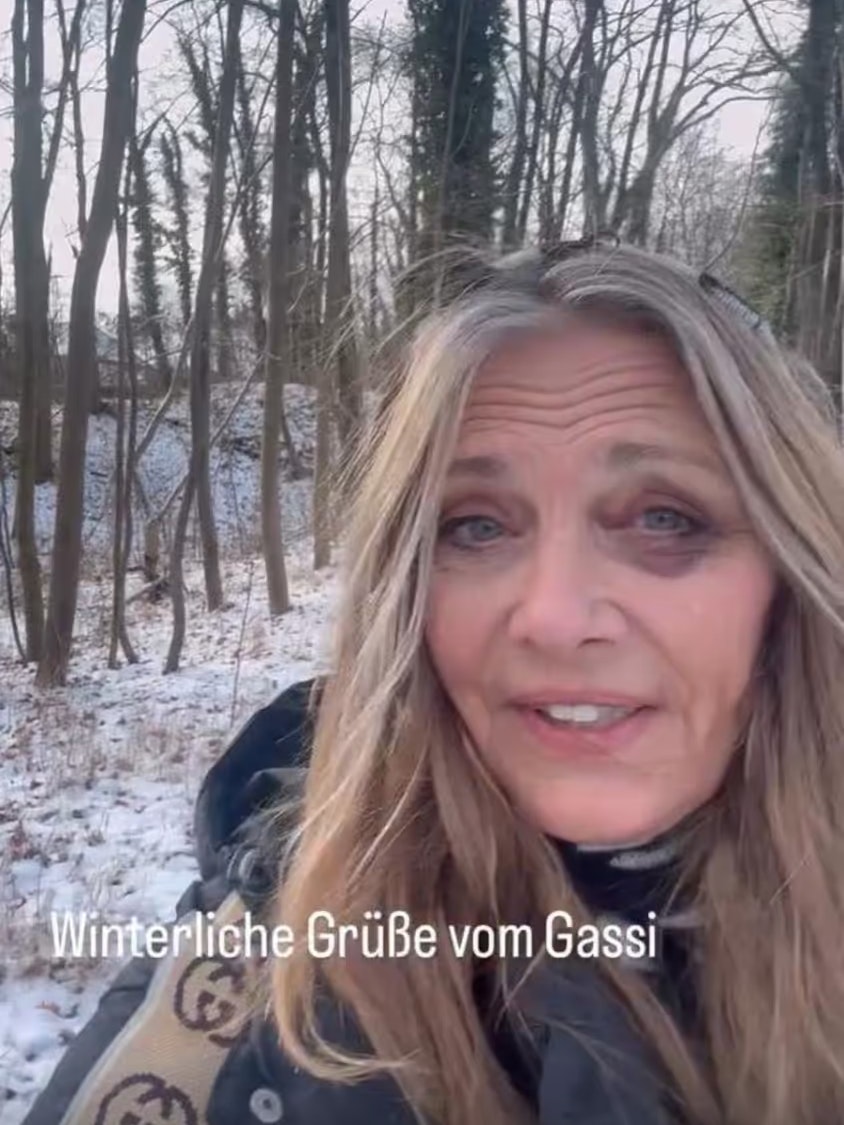 Nicole Bestler-Boettcher hat sich kurz vor dem Abflug ins Dschungelcamp ein blaues Auge zugelegt.