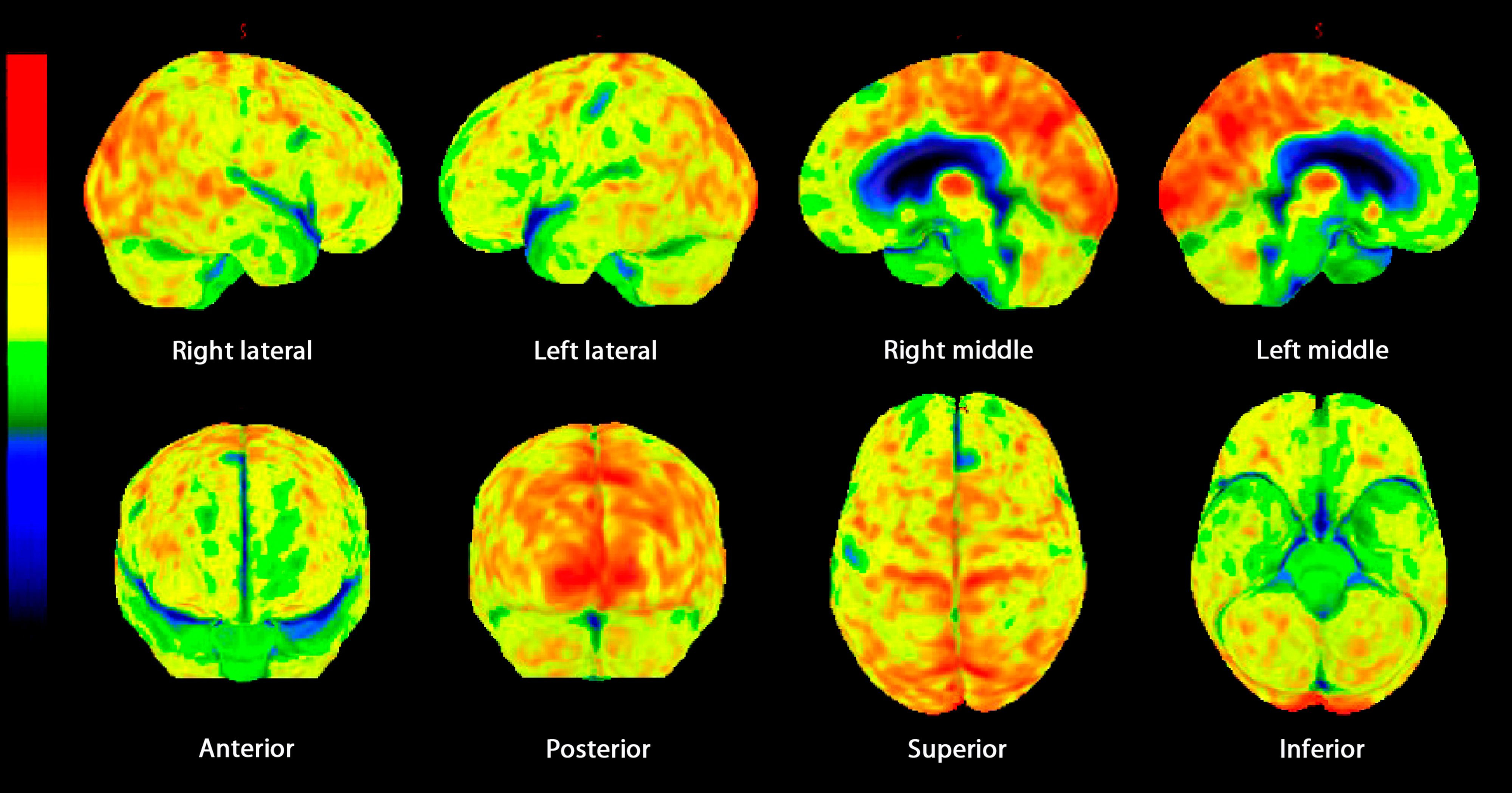 Heute.at - Jüngster Demenz-Kranker stirbt mit nur 24 Jahren