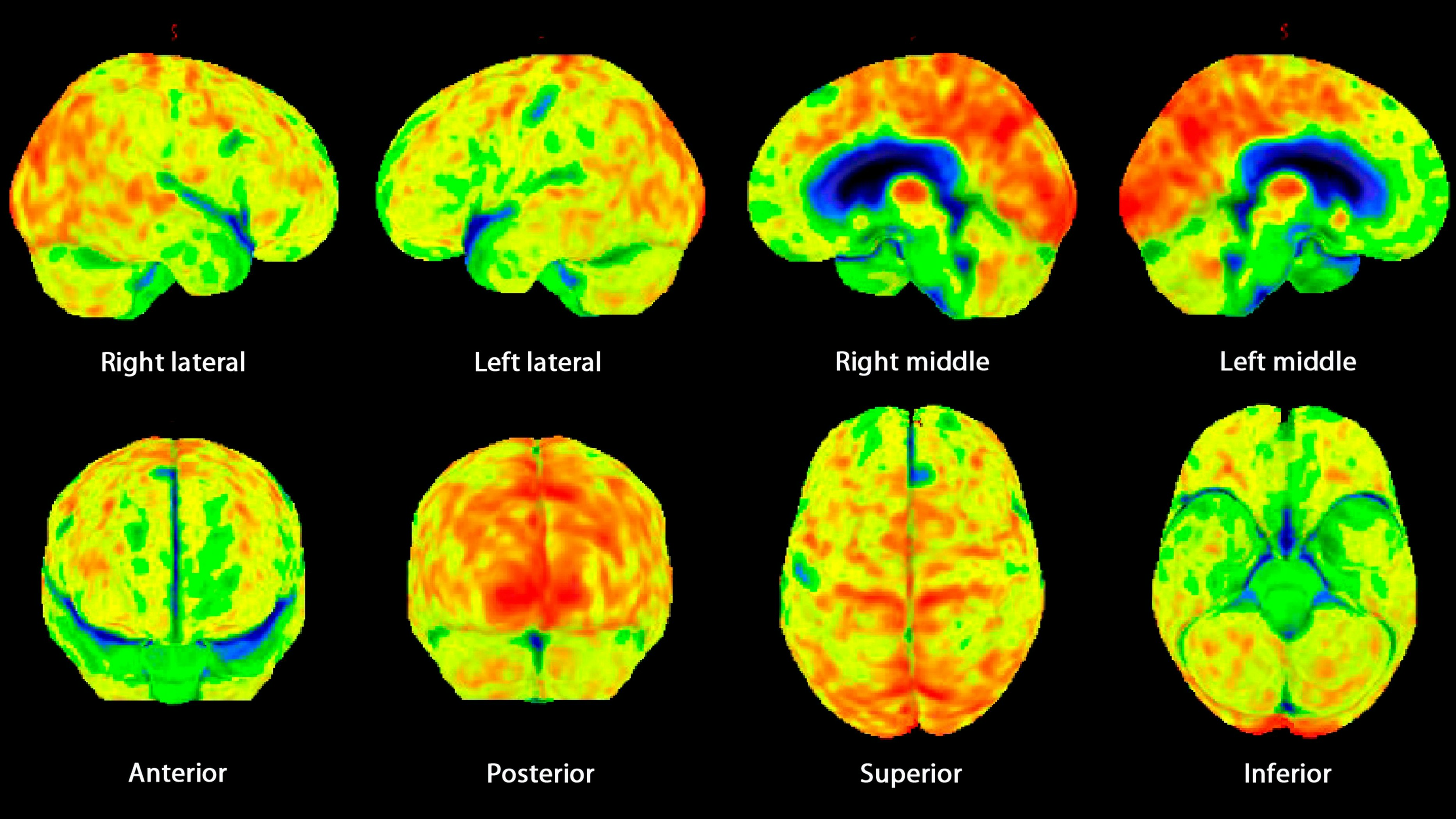 Heute.at - Jüngster Demenz-Kranker stirbt mit nur 24 Jahren
