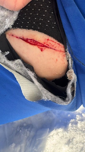 Medizinisches Zentrum Gänserndorf: Nach Skiunfall wird verletzter Mann mit offener Wunde abgewiesen. Der Vorfall sorgt für großes Unverständnis.