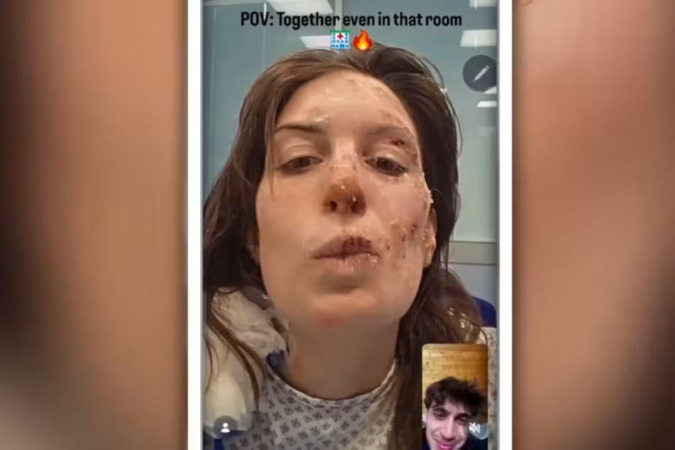 Heute.at - Emotionales Posting – Eleonora (29) zeigt Brandwunden