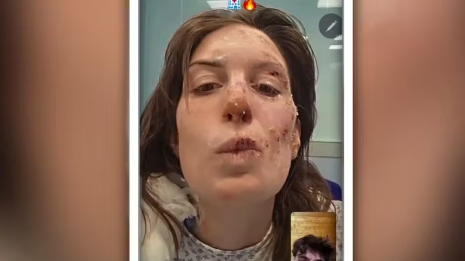 Heute.at - Emotionales Posting – Eleonora (29) zeigt Brandwunden