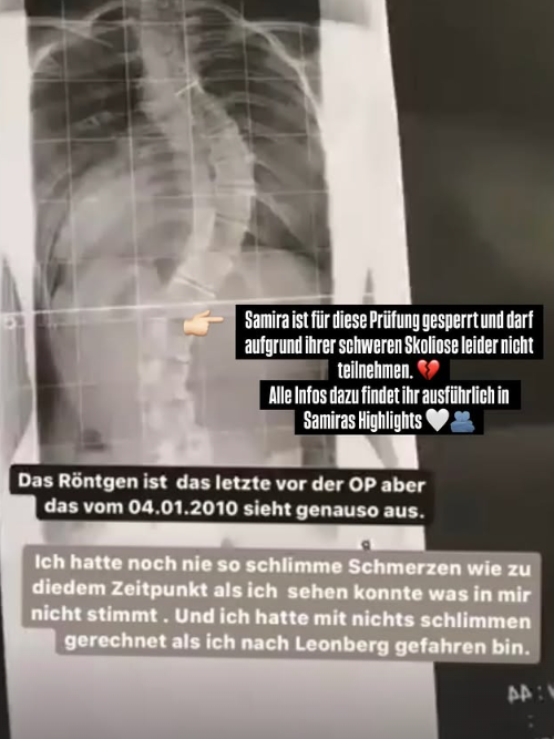 Auf Instagram machte Samira mit einem Röntgenbild auf die Verkrümmung ihrer Wirbelsäule aufmerksam.