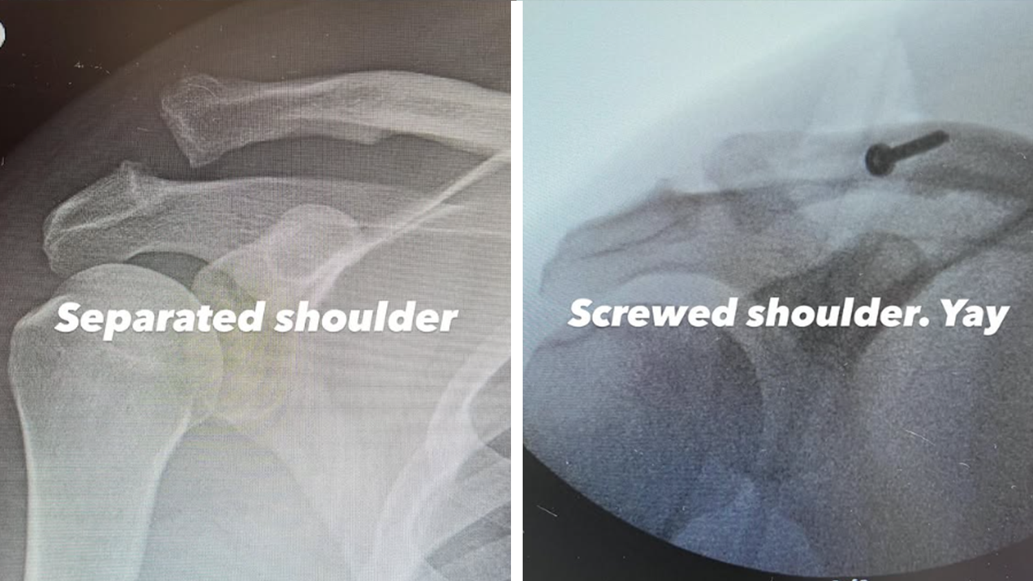 Channing Tatum zeigt seine Schulter vor und nach der Operation. Offenbar wurde seine ausgekugelte Schulter mit einer Schraube stabilisiert.