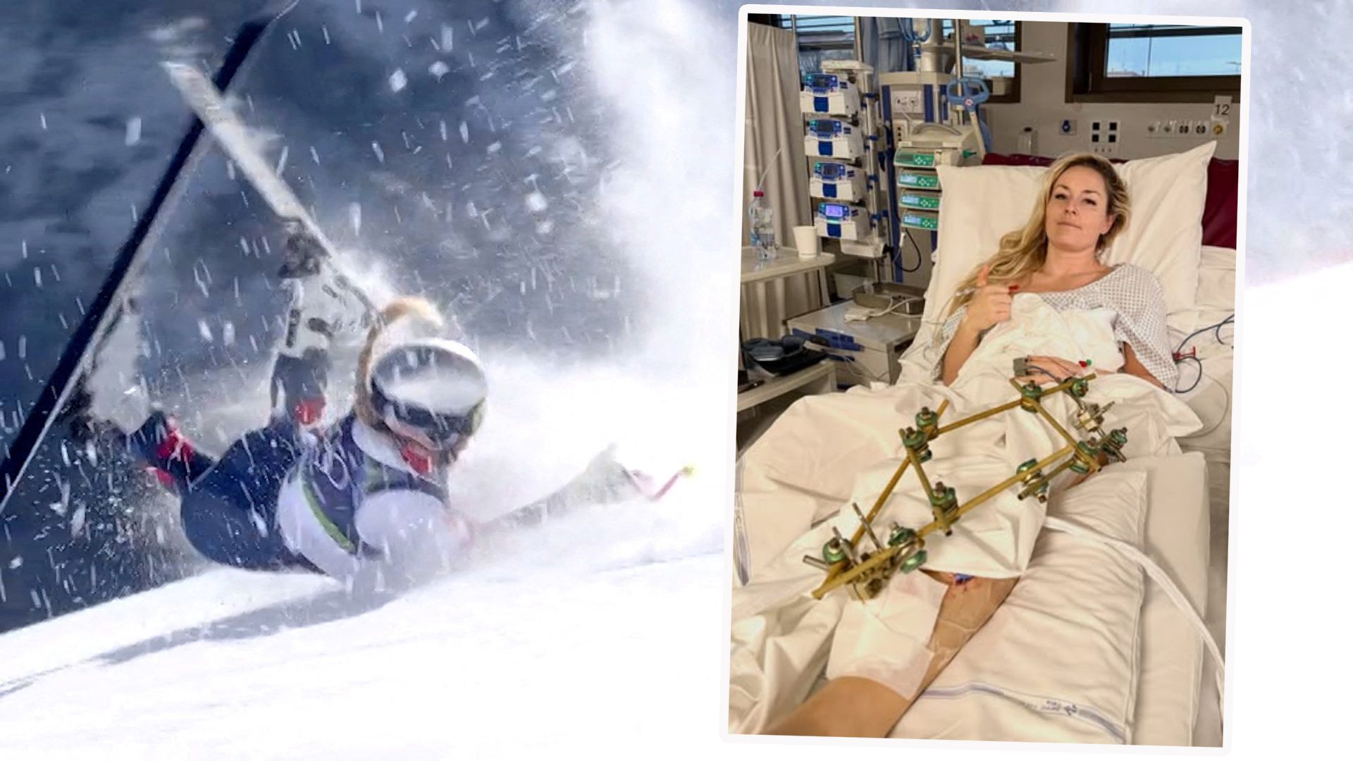 Lindsey Vonn mit ihrem kaputten Fuß nach OP Nummer drei.