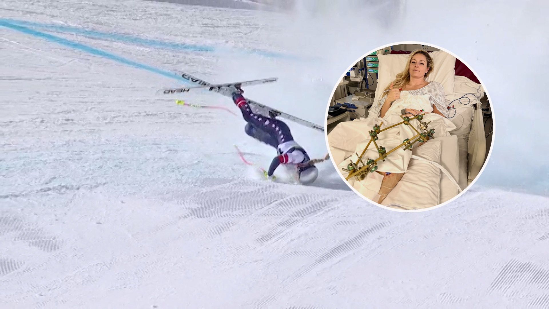 Lindsey Vonn mit ihrem kaputten Fuß nach OP Nummer drei.
