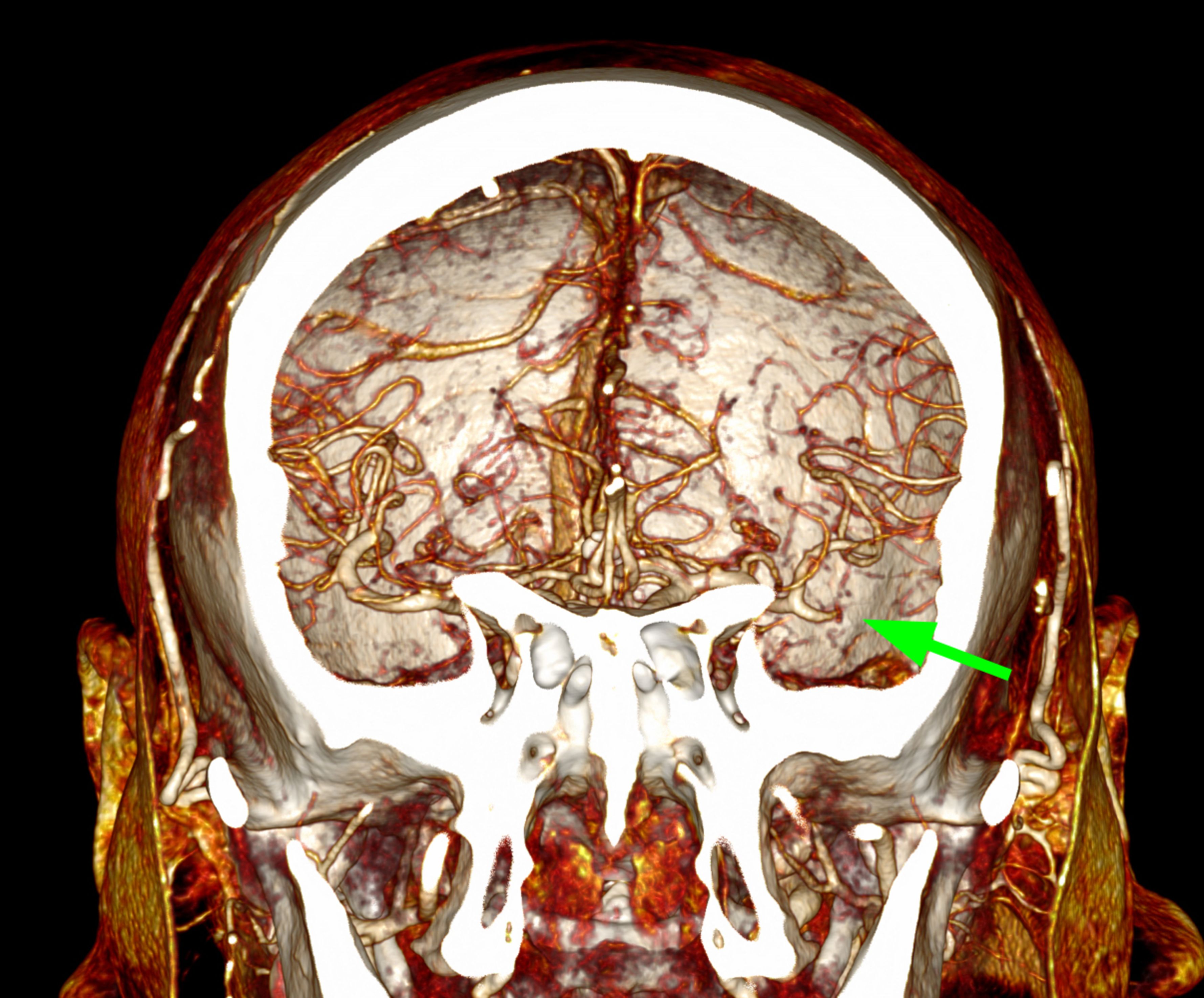 MRT-Angiogramm eines koronalen Schnitts durch das Gehirn, das eine Thrombose der mittleren Hirnarterie (grüner Pfeil) zeigt.