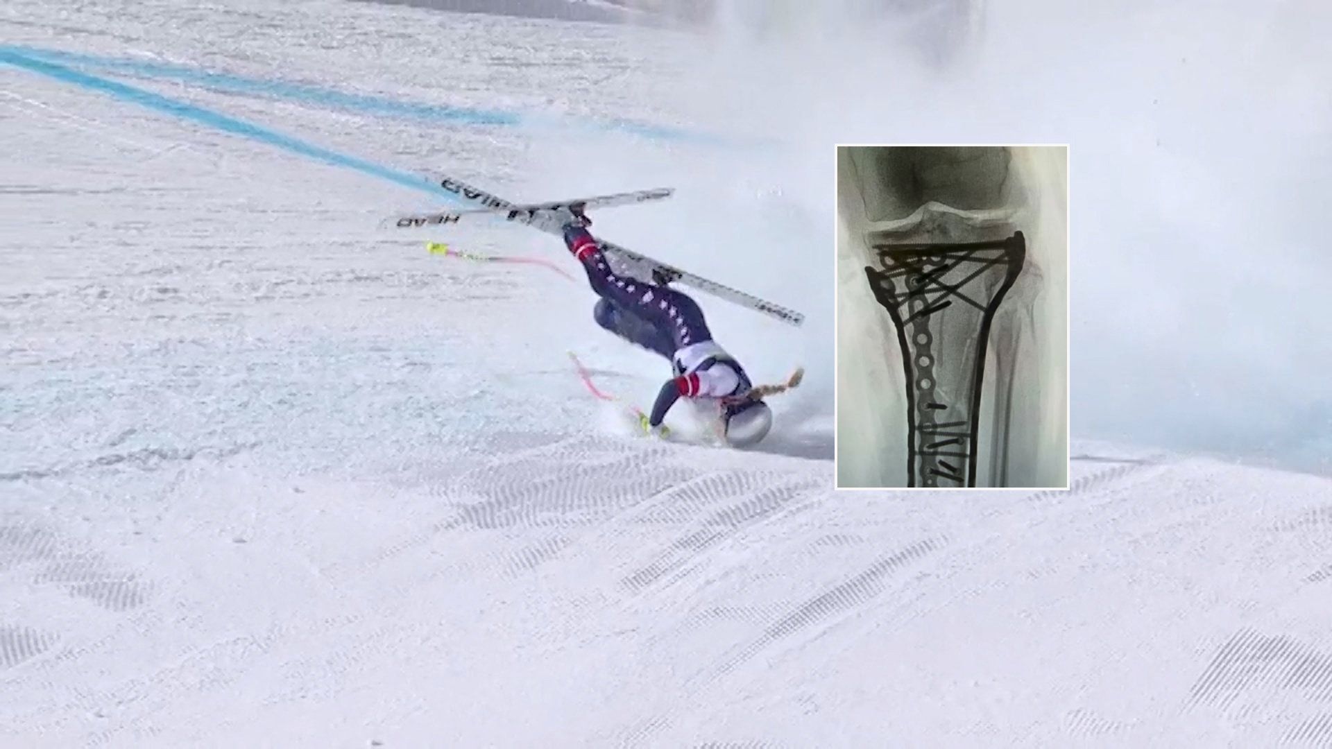 Lindsey Vonn und ein Röntgenbild ihres operierten Beines.
