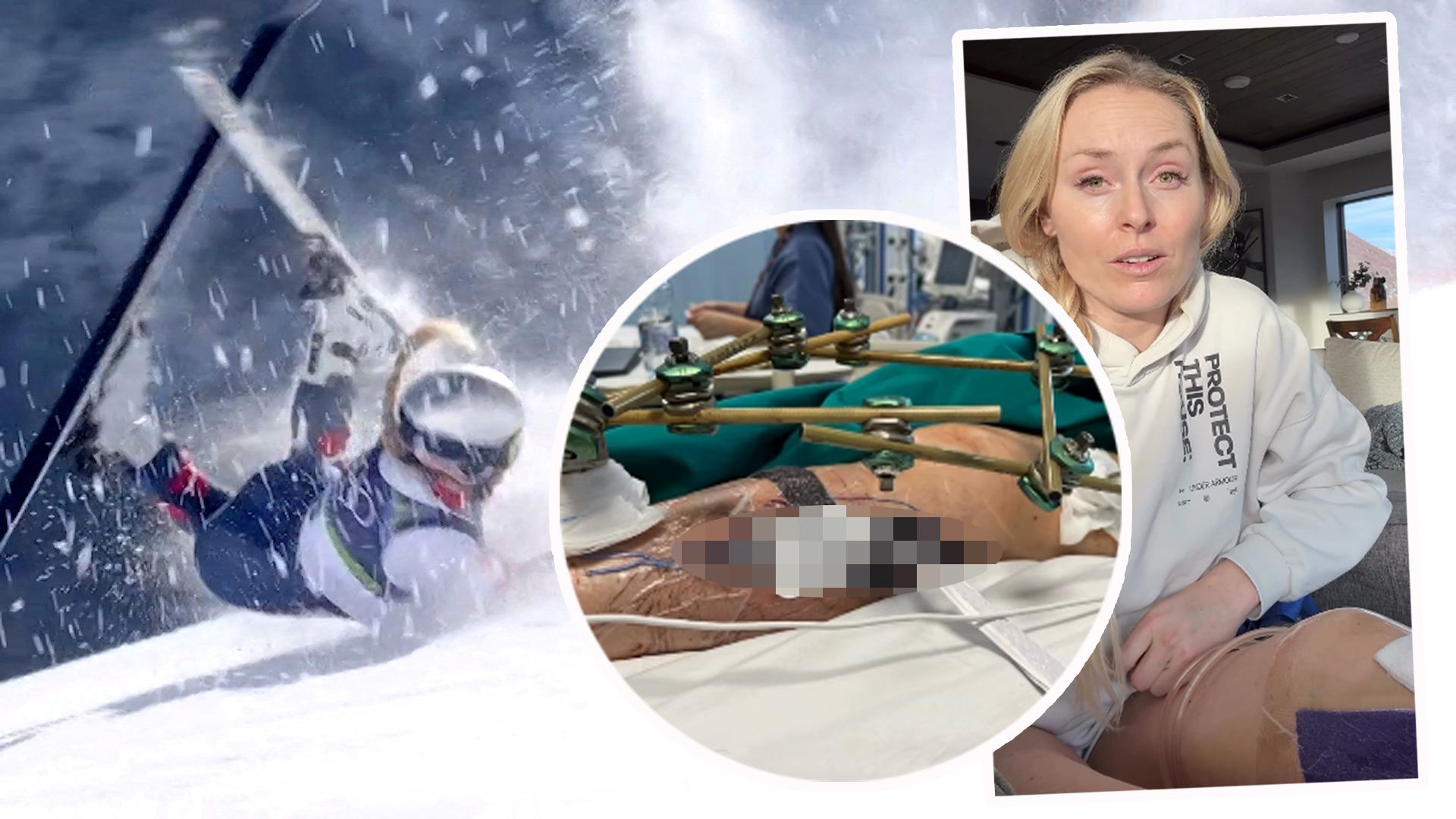 Lindsey Vonn zeigt grausame Bilder ihrer Wunde.