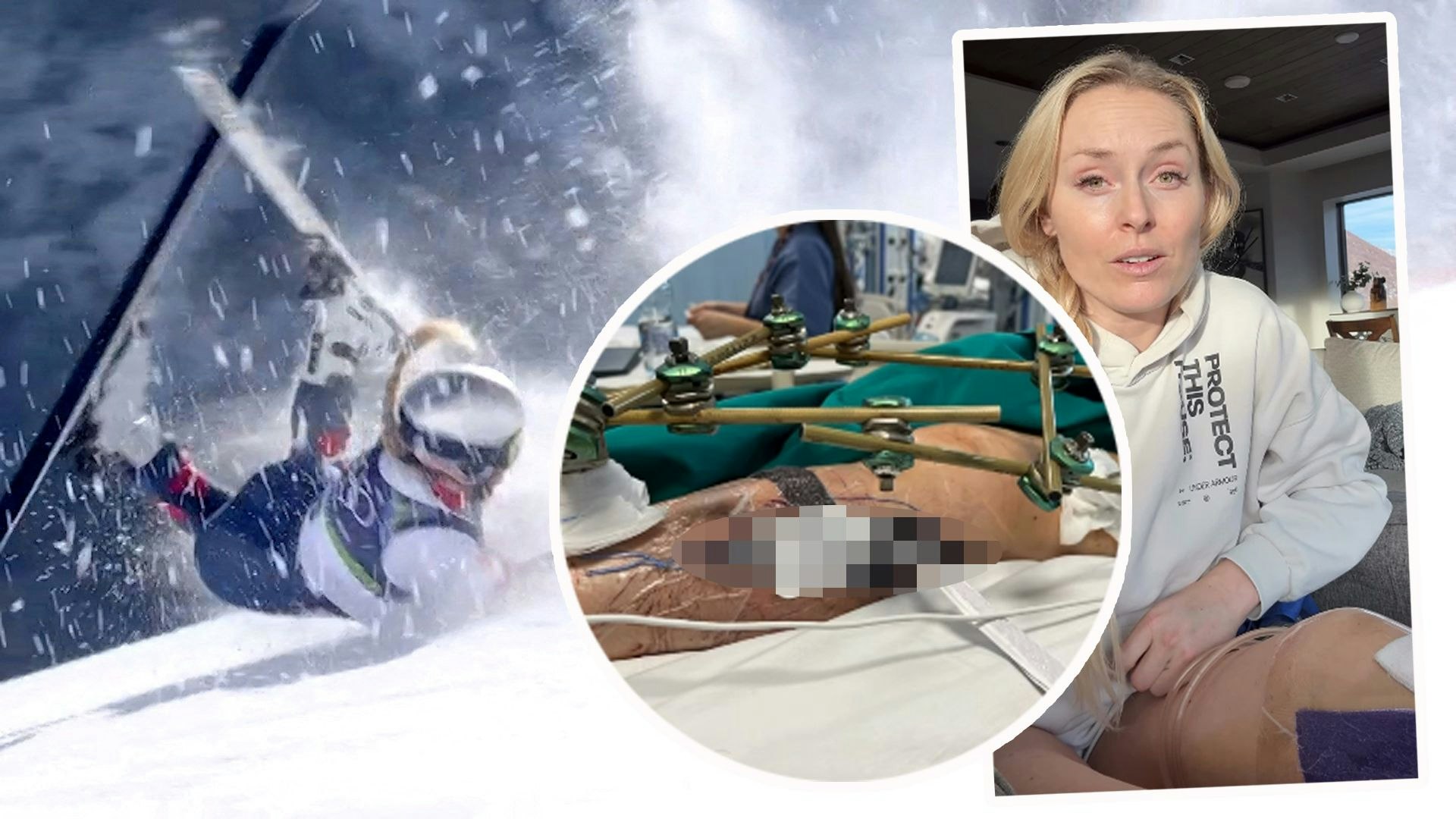 Lindsey Vonn zeigt grausame Bilder ihrer Wunde.