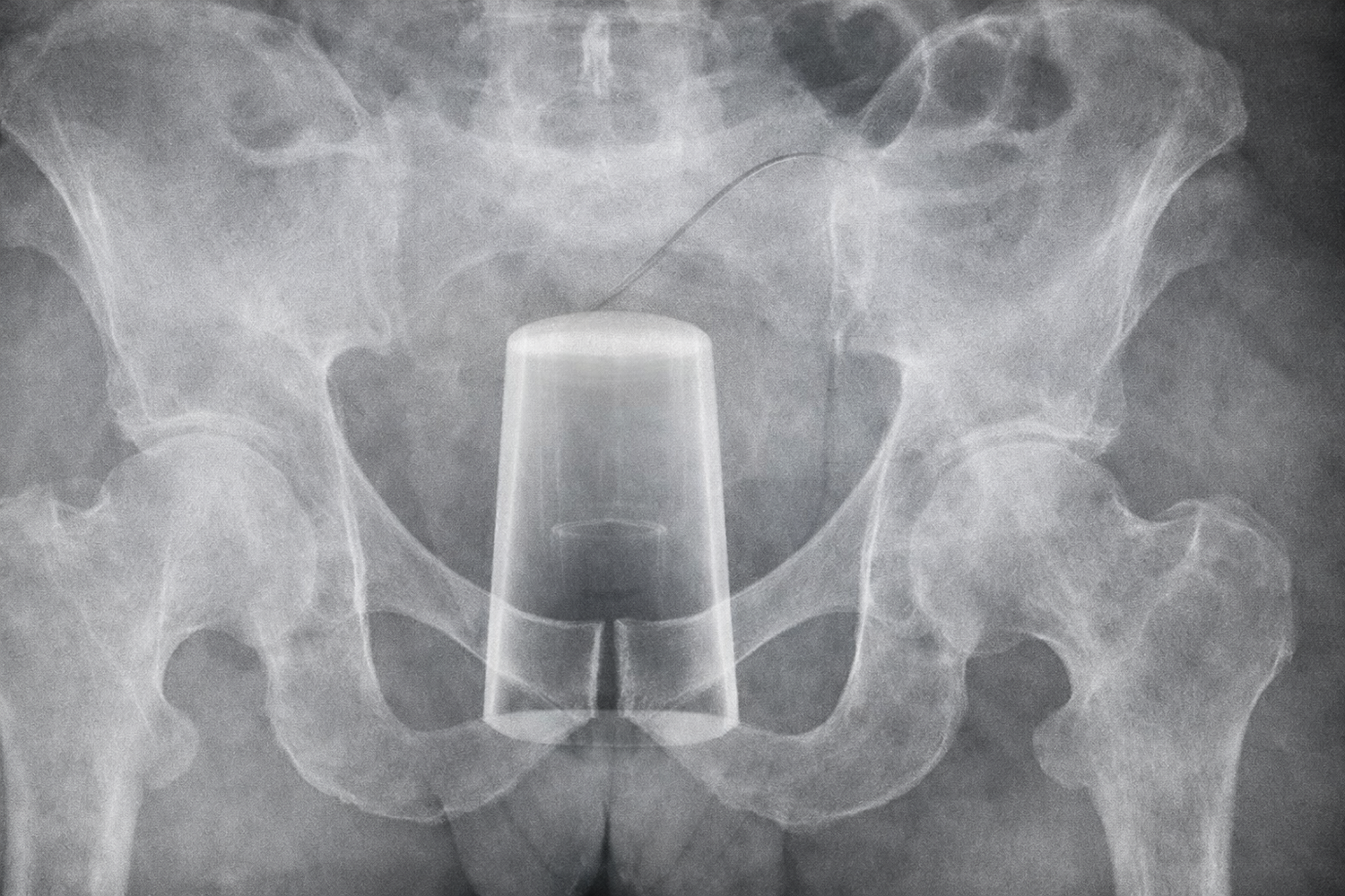 So ähnlich sah das Röntgenbild von Dmitri aus.