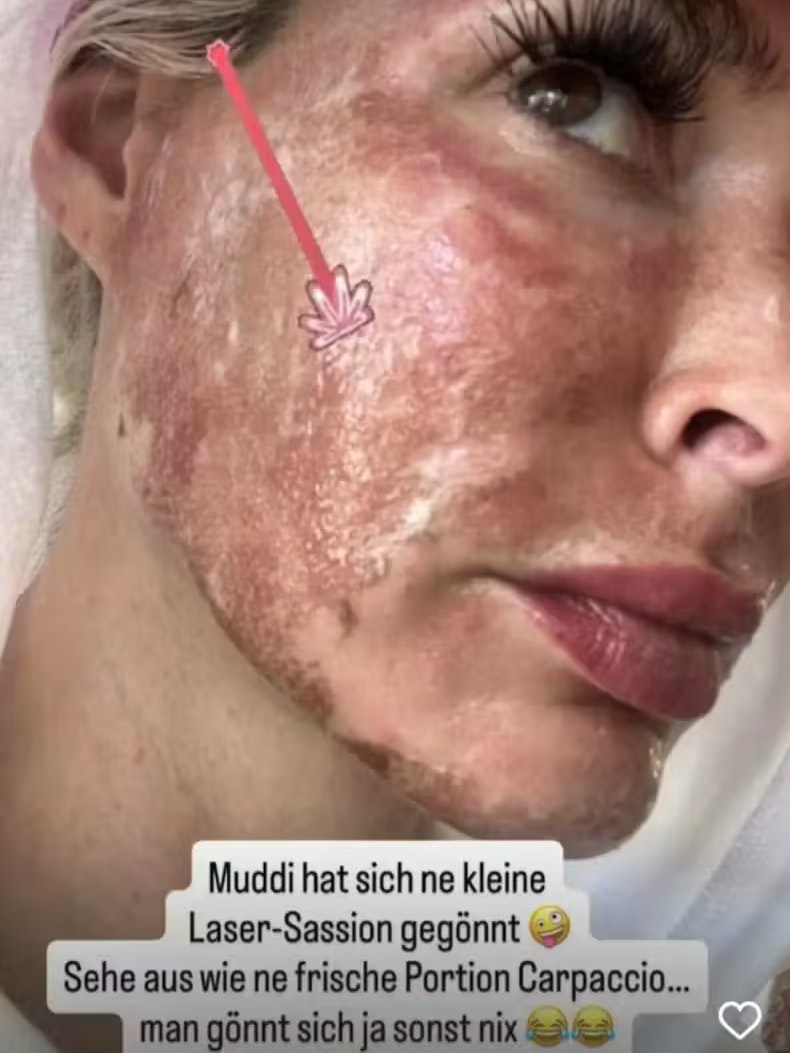 Daniela Katzenberger postete ihr "Carpacchio"-Gesicht auf Instagram