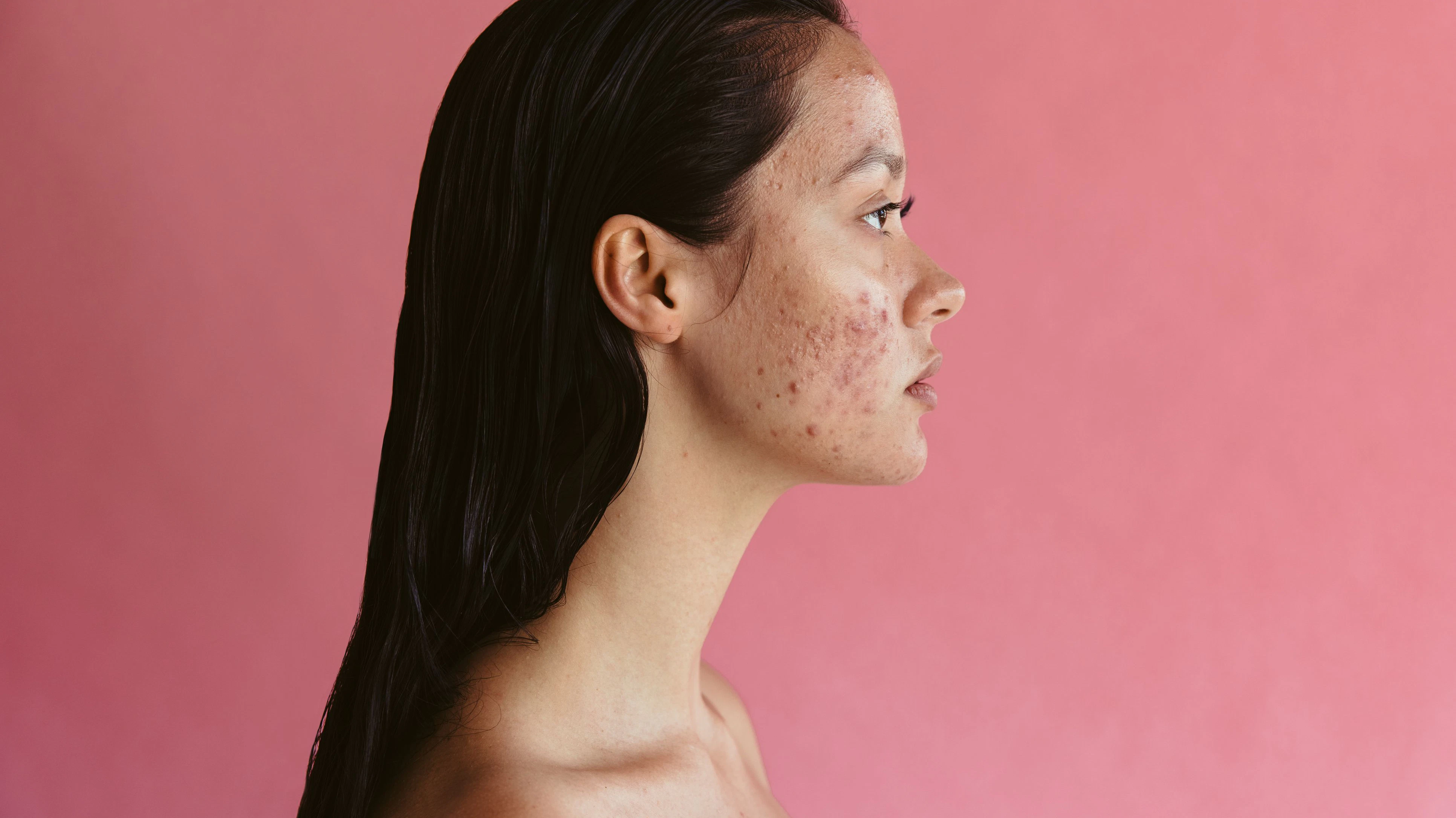 Heute.at - Pickel wollen nicht heilen? So erkennst du PCOS-Akne