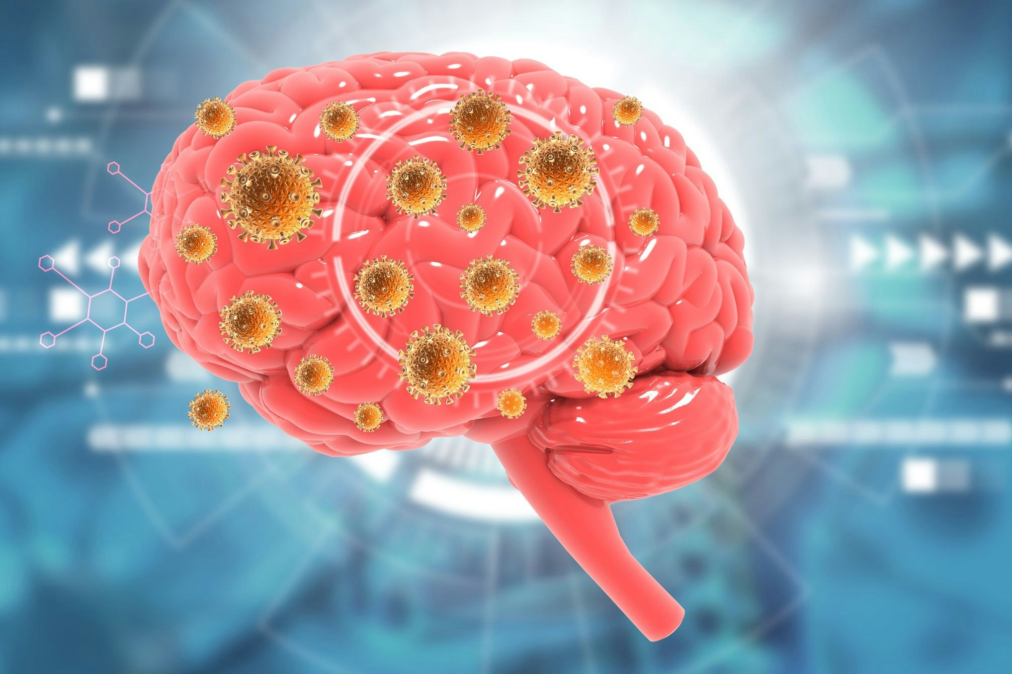 Eine Hirnhautentzündung kann durch Viren (wie hier) oder – noch wesentlich gefährlicher – durch Bakterien ausgelöst werden