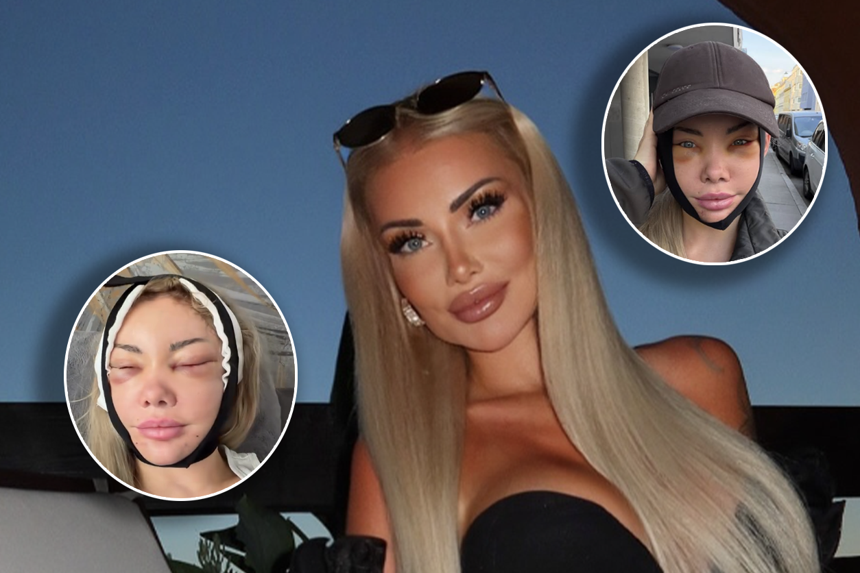 Sabrina Wlk zeigt ihr Gesicht nach der Operation.