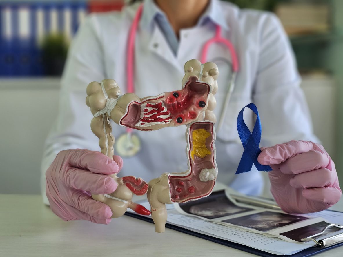 Neue Studie zeigt: Stuhltest und Darmspiegelung wirken – aber nicht gleich.