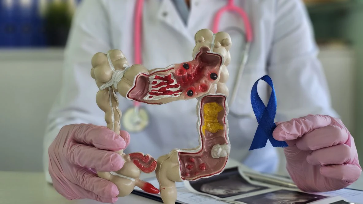 A healthcare professional demonstrates a digestive system model while holding a blue awareness ribbon, emphasizing the importance of gut health in a clinical environment.