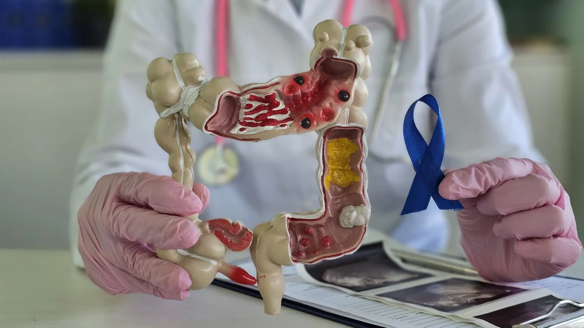 Heute.at - Darmkrebs – diese Vorsorgemethode bringt mehr