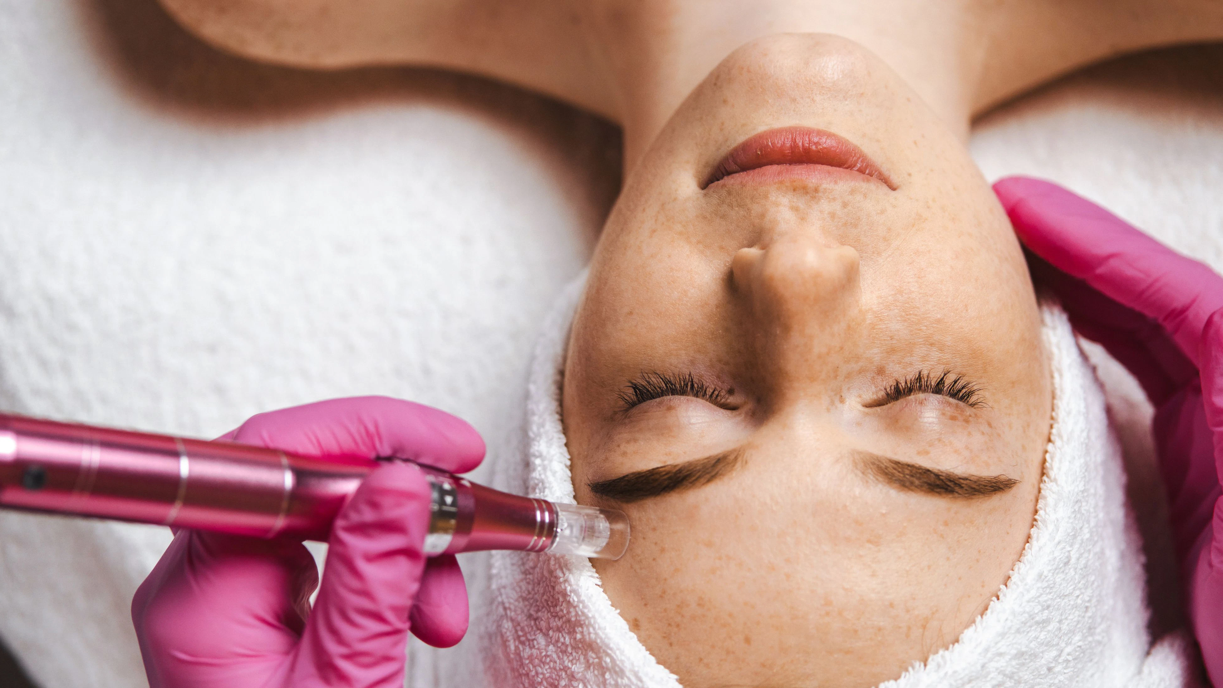 Microneedling...