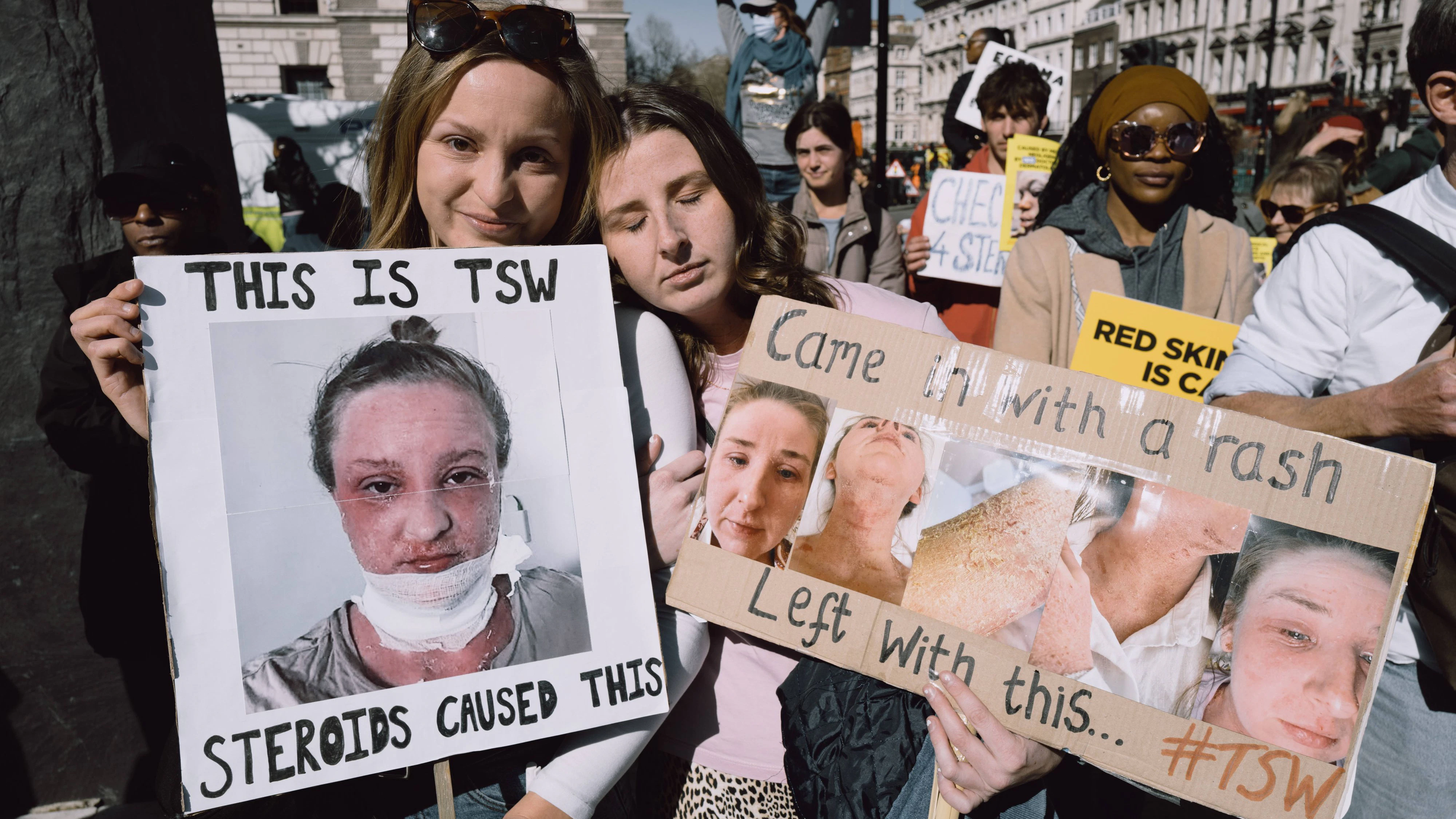 "Topical Steroid Withdrawal", kurz TSW, sorgt oft für jahrelanges Leid.