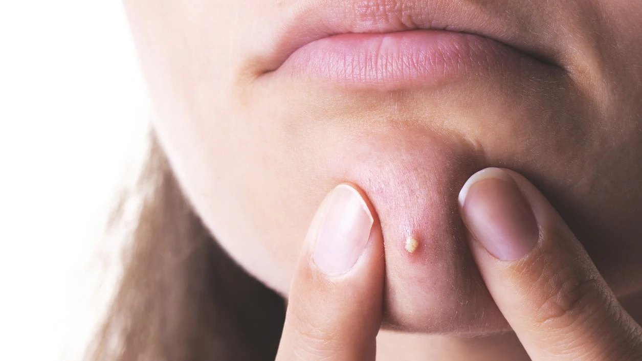 Heute.at - Warum sich Pickel ausdrücken so gut anfühlt