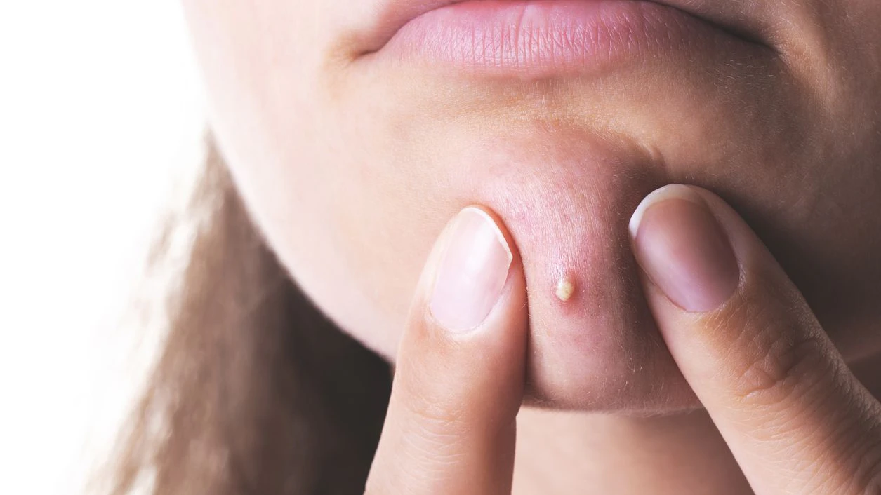 young woman having acne problem
