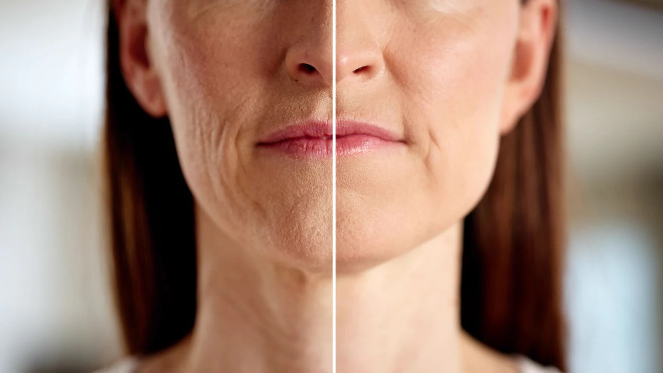 The Transformation of a Woman's Skin: Microdermabrasion Before & After.